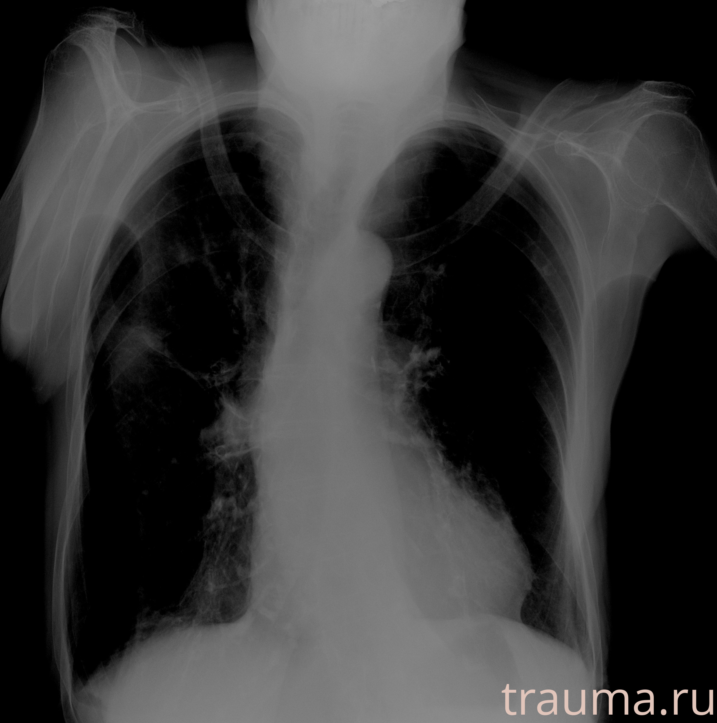 Рентген на дому: по вашему адресу приезжает врач-рентгенолог, травматолог-ортопед с мобильным рентгеновским аппаратом, проводит диагностику травмы или заболевания, делает необходимые рентгенограммы, дает рекомендации по дальнейшему лечению. Получить качественные снимки в домашних условиях возможно благодаря уникальной методике, разработанной МосРентген Центром для института  Склифосовского