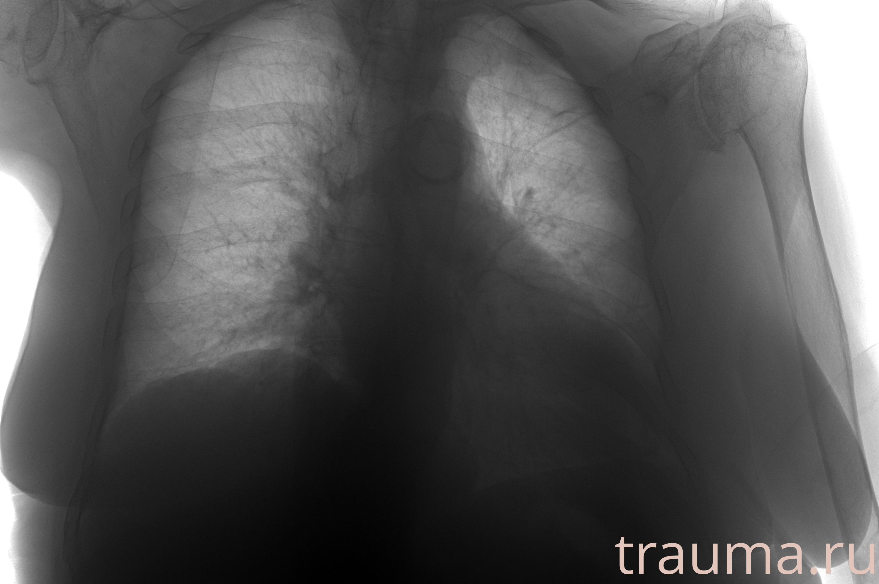 Рентген на дому: по вашему адресу приезжает врач-рентгенолог, травматолог-ортопед с мобильным рентгеновским аппаратом, проводит диагностику травмы или заболевания, делает необходимые рентгенограммы, дает рекомендации по дальнейшему лечению. Получить качественные снимки в домашних условиях возможно благодаря уникальной методике, разработанной МосРентген Центром для института  Склифосовского