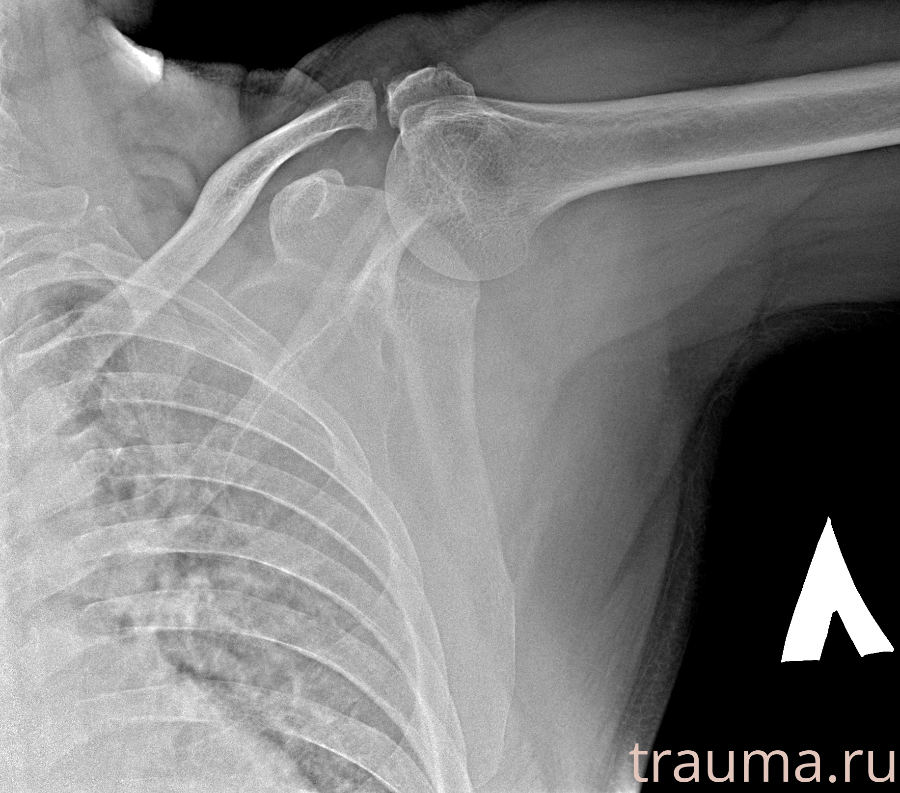 Рентген на дому: по вашему адресу приезжает врач-рентгенолог, травматолог-ортопед с мобильным рентгеновским аппаратом, проводит диагностику травмы или заболевания, делает необходимые рентгенограммы, дает рекомендации по дальнейшему лечению. Получить качественные снимки в домашних условиях возможно благодаря уникальной методике, разработанной МосРентген Центром для института  Склифосовского