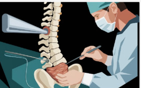 Позвоночно-тазовая фиксация при нейрогенных сколиозах: обоснованность показаний
