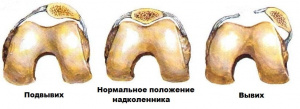 Вывих надколенника, развившийся при переломе бедренной кости 