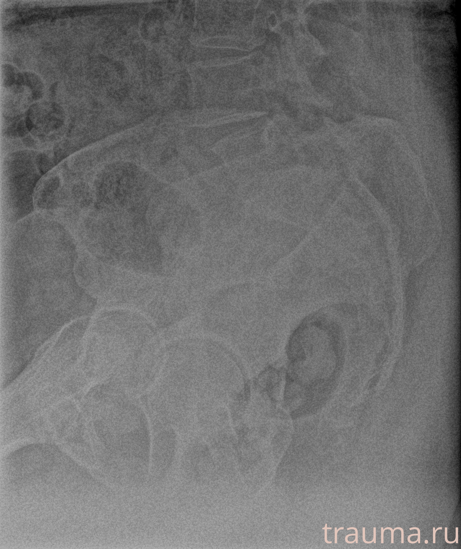 Рентген на дому: по вашему адресу приезжает врач-рентгенолог, травматолог-ортопед с мобильным рентгеновским аппаратом, проводит диагностику травмы или заболевания, делает необходимые рентгенограммы, дает рекомендации по дальнейшему лечению. Получить качественные снимки в домашних условиях возможно благодаря уникальной методике, разработанной МосРентген Центром для института  Склифосовского