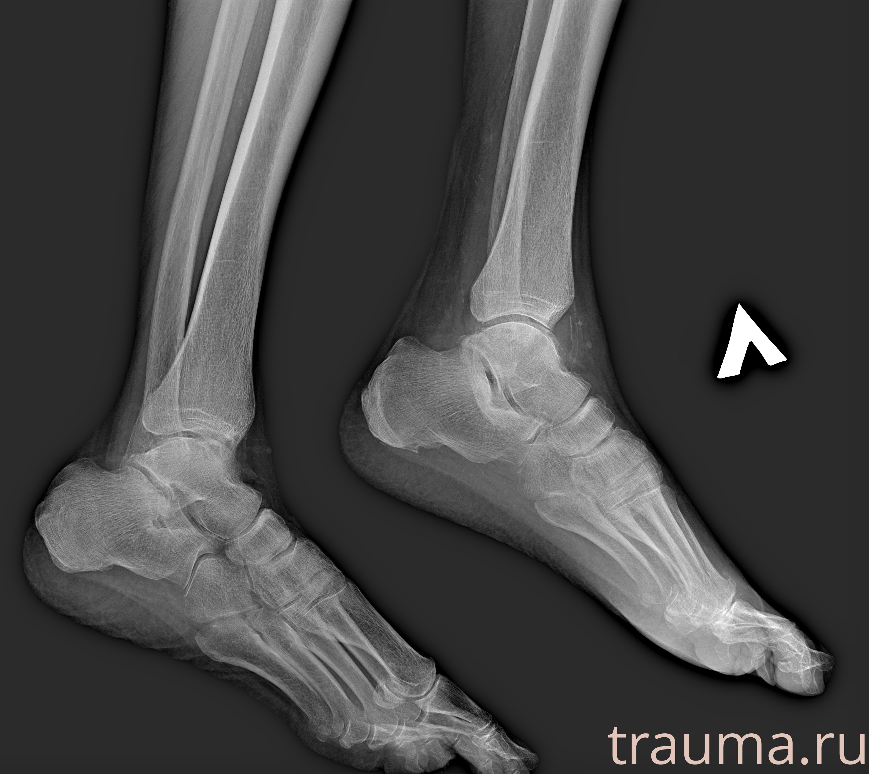 Рентген на дому: по вашему адресу приезжает врач-рентгенолог, травматолог-ортопед с мобильным рентгеновским аппаратом, проводит диагностику травмы или заболевания, делает необходимые рентгенограммы, дает рекомендации по дальнейшему лечению. Получить качественные снимки в домашних условиях возможно благодаря уникальной методике, разработанной МосРентген Центром для института  Склифосовского