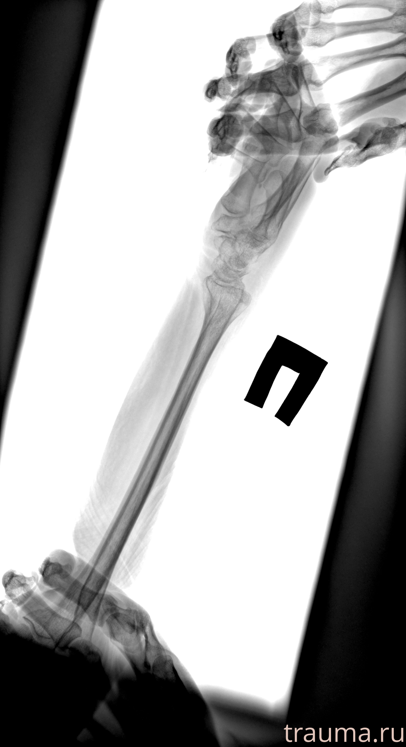 Рентген на дому: по вашему адресу приезжает врач-рентгенолог, травматолог-ортопед с мобильным рентгеновским аппаратом, проводит диагностику травмы или заболевания, делает необходимые рентгенограммы, дает рекомендации по дальнейшему лечению. Получить качественные снимки в домашних условиях возможно благодаря уникальной методике, разработанной МосРентген Центром для института  Склифосовского