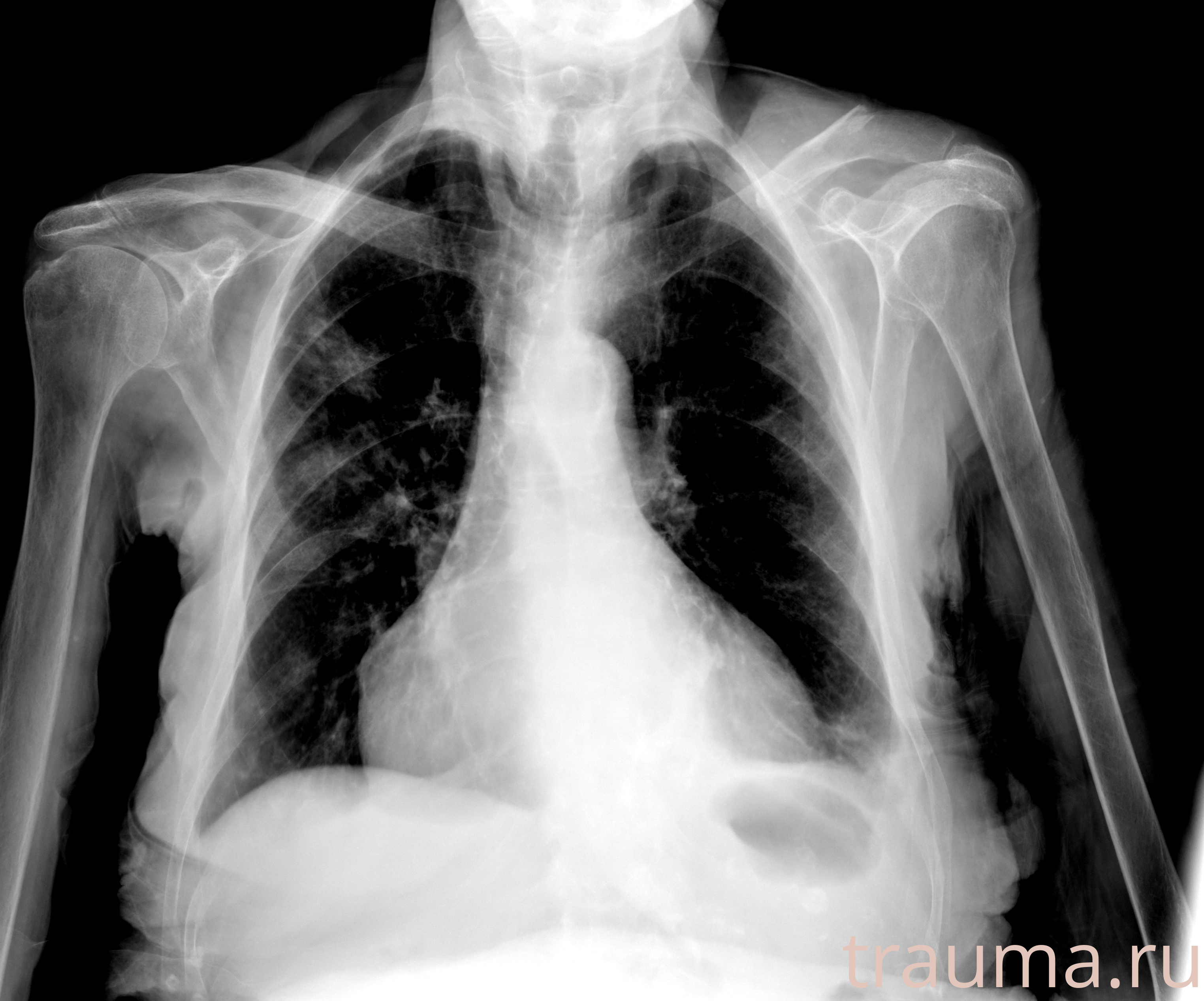 Рентген на дому: по вашему адресу приезжает врач-рентгенолог, травматолог-ортопед с мобильным рентгеновским аппаратом, проводит диагностику травмы или заболевания, делает необходимые рентгенограммы, дает рекомендации по дальнейшему лечению. Получить качественные снимки в домашних условиях возможно благодаря уникальной методике, разработанной МосРентген Центром для института  Склифосовского