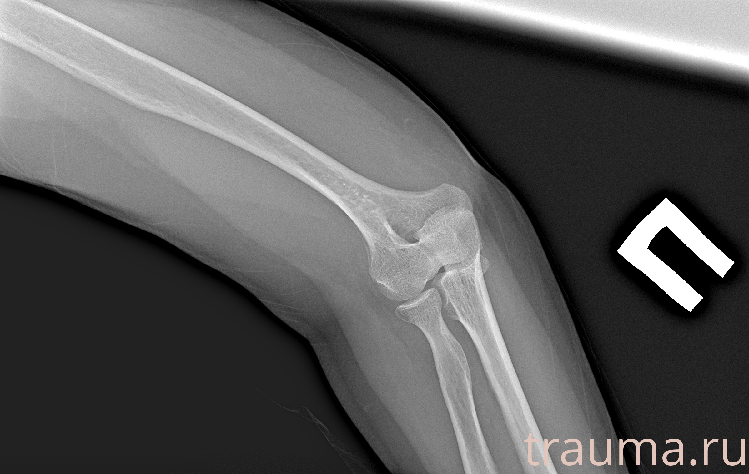 Рентген на дому: по вашему адресу приезжает врач-рентгенолог, травматолог-ортопед с мобильным рентгеновским аппаратом, проводит диагностику травмы или заболевания, делает необходимые рентгенограммы, дает рекомендации по дальнейшему лечению. Получить качественные снимки в домашних условиях возможно благодаря уникальной методике, разработанной МосРентген Центром для института  Склифосовского