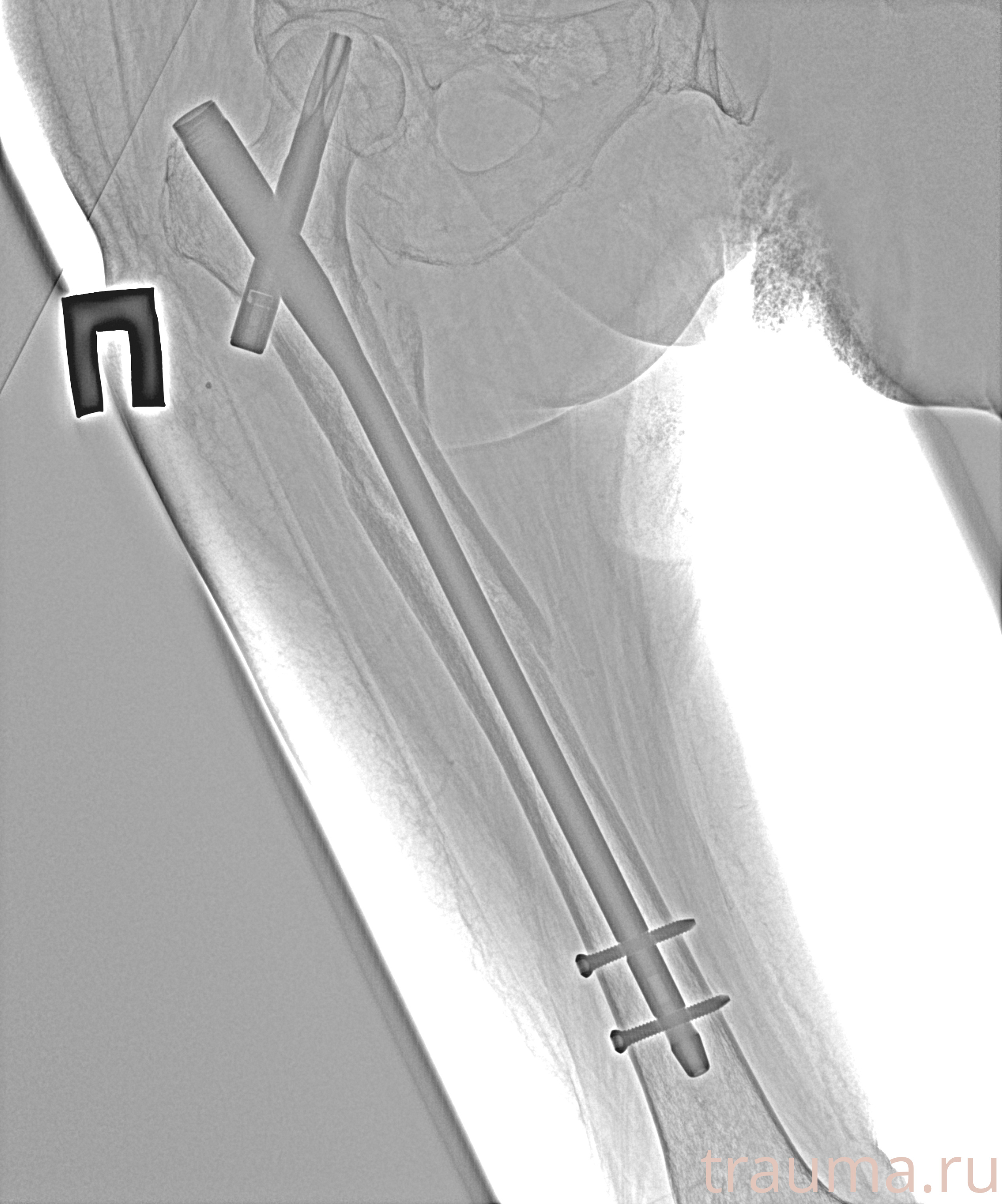 Рентген на дому: по вашему адресу приезжает врач-рентгенолог, травматолог-ортопед с мобильным рентгеновским аппаратом, проводит диагностику травмы или заболевания, делает необходимые рентгенограммы, дает рекомендации по дальнейшему лечению. Получить качественные снимки в домашних условиях возможно благодаря уникальной методике, разработанной МосРентген Центром для института  Склифосовского