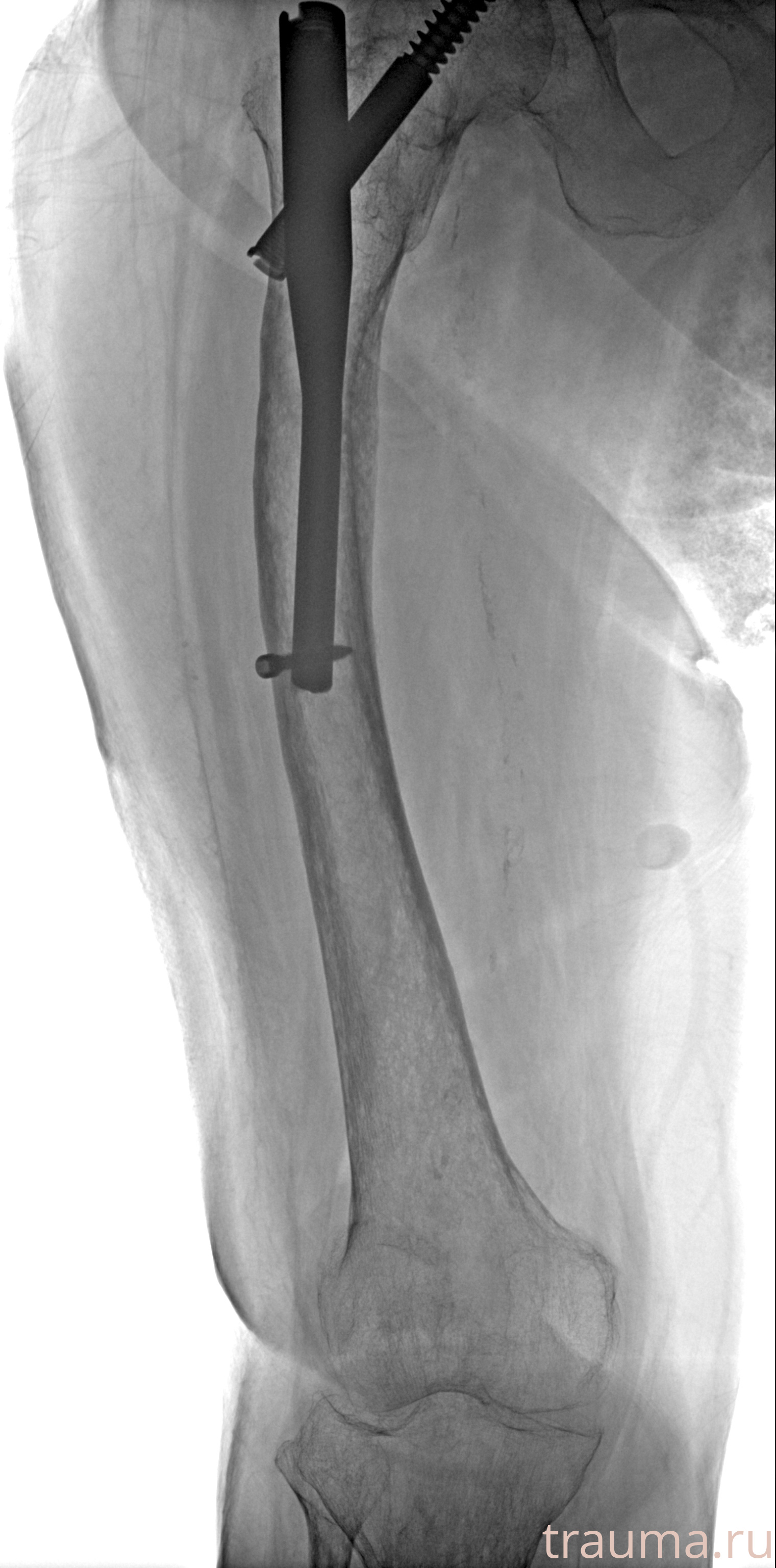 Рентген на дому: по вашему адресу приезжает врач-рентгенолог, травматолог-ортопед с мобильным рентгеновским аппаратом, проводит диагностику травмы или заболевания, делает необходимые рентгенограммы, дает рекомендации по дальнейшему лечению. Получить качественные снимки в домашних условиях возможно благодаря уникальной методике, разработанной МосРентген Центром для института  Склифосовского