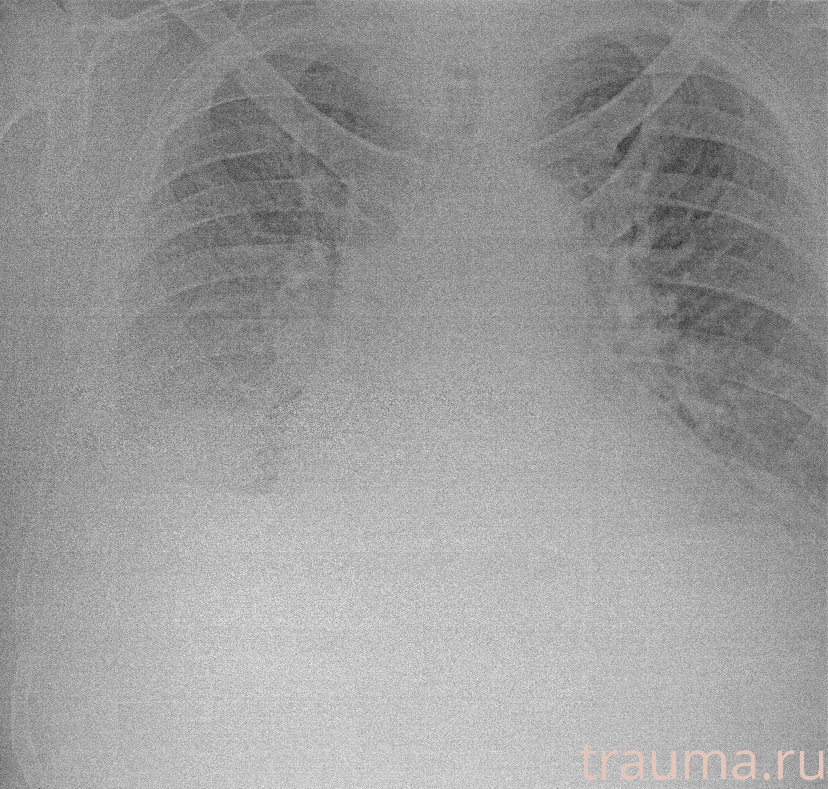 Рентген на дому: по вашему адресу приезжает врач-рентгенолог, травматолог-ортопед с мобильным рентгеновским аппаратом, проводит диагностику травмы или заболевания, делает необходимые рентгенограммы, дает рекомендации по дальнейшему лечению. Получить качественные снимки в домашних условиях возможно благодаря уникальной методике, разработанной МосРентген Центром для института  Склифосовского