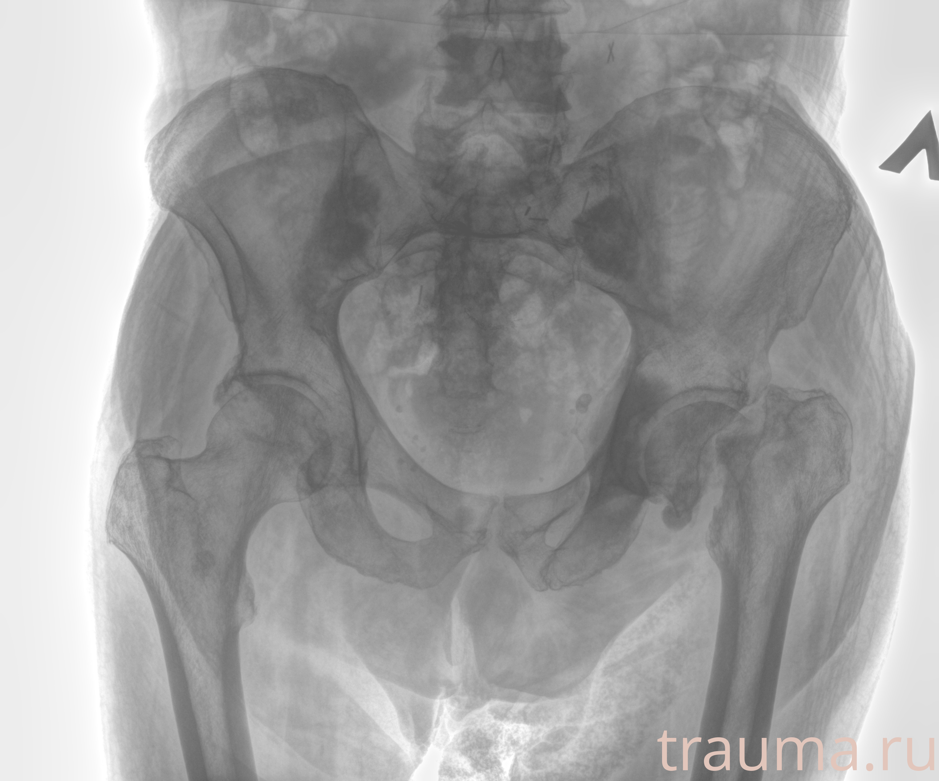 Рентген на дому: по вашему адресу приезжает врач-рентгенолог, травматолог-ортопед с мобильным рентгеновским аппаратом, проводит диагностику травмы или заболевания, делает необходимые рентгенограммы, дает рекомендации по дальнейшему лечению. Получить качественные снимки в домашних условиях возможно благодаря уникальной методике, разработанной МосРентген Центром для института  Склифосовского