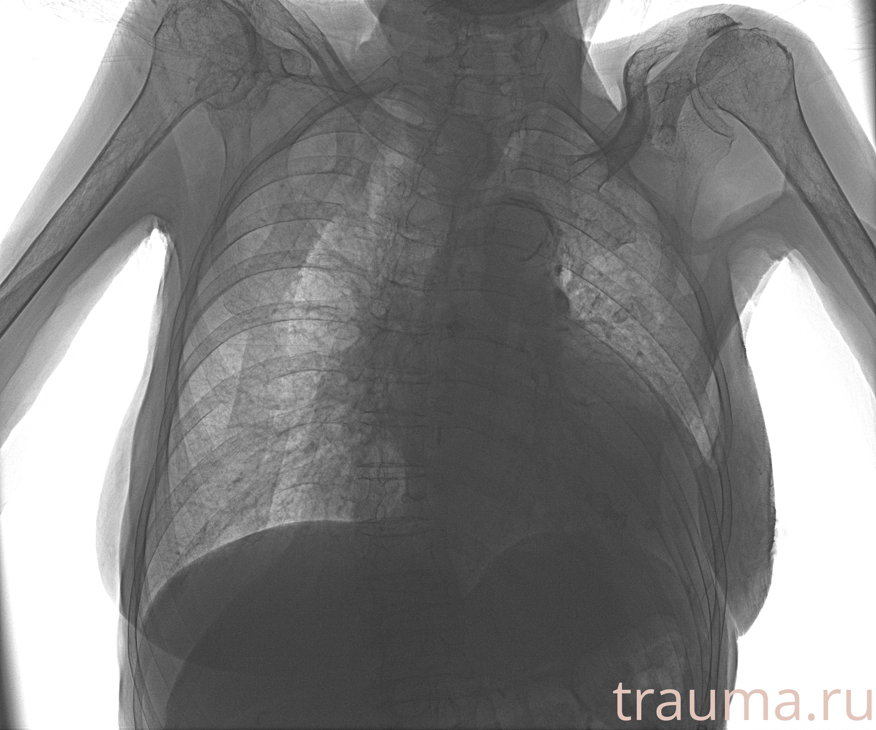 Рентген на дому: по вашему адресу приезжает врач-рентгенолог, травматолог-ортопед с мобильным рентгеновским аппаратом, проводит диагностику травмы или заболевания, делает необходимые рентгенограммы, дает рекомендации по дальнейшему лечению. Получить качественные снимки в домашних условиях возможно благодаря уникальной методике, разработанной МосРентген Центром для института  Склифосовского