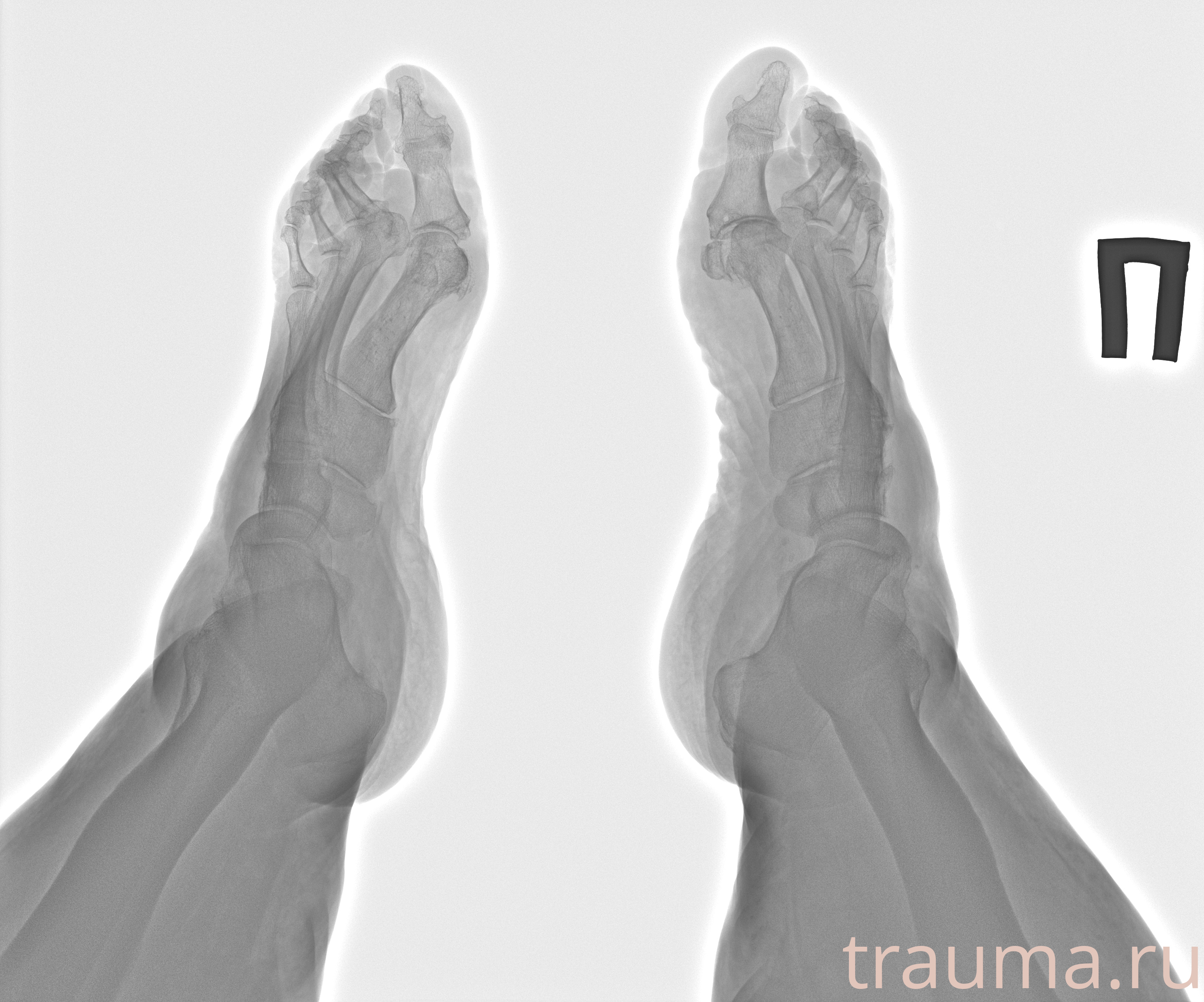 Рентген на дому: по вашему адресу приезжает врач-рентгенолог, травматолог-ортопед с мобильным рентгеновским аппаратом, проводит диагностику травмы или заболевания, делает необходимые рентгенограммы, дает рекомендации по дальнейшему лечению. Получить качественные снимки в домашних условиях возможно благодаря уникальной методике, разработанной МосРентген Центром для института  Склифосовского