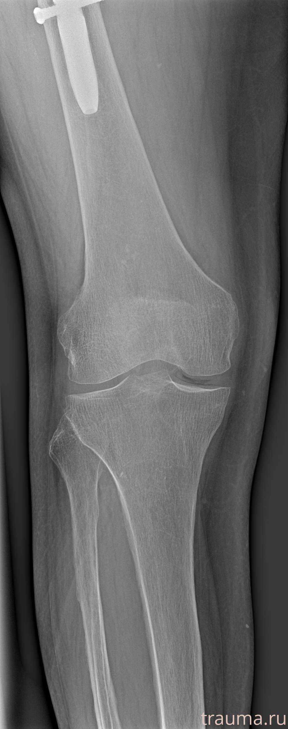 Рентген на дому: по вашему адресу приезжает врач-рентгенолог, травматолог-ортопед с мобильным рентгеновским аппаратом, проводит диагностику травмы или заболевания, делает необходимые рентгенограммы, дает рекомендации по дальнейшему лечению. Получить качественные снимки в домашних условиях возможно благодаря уникальной методике, разработанной МосРентген Центром для института  Склифосовского