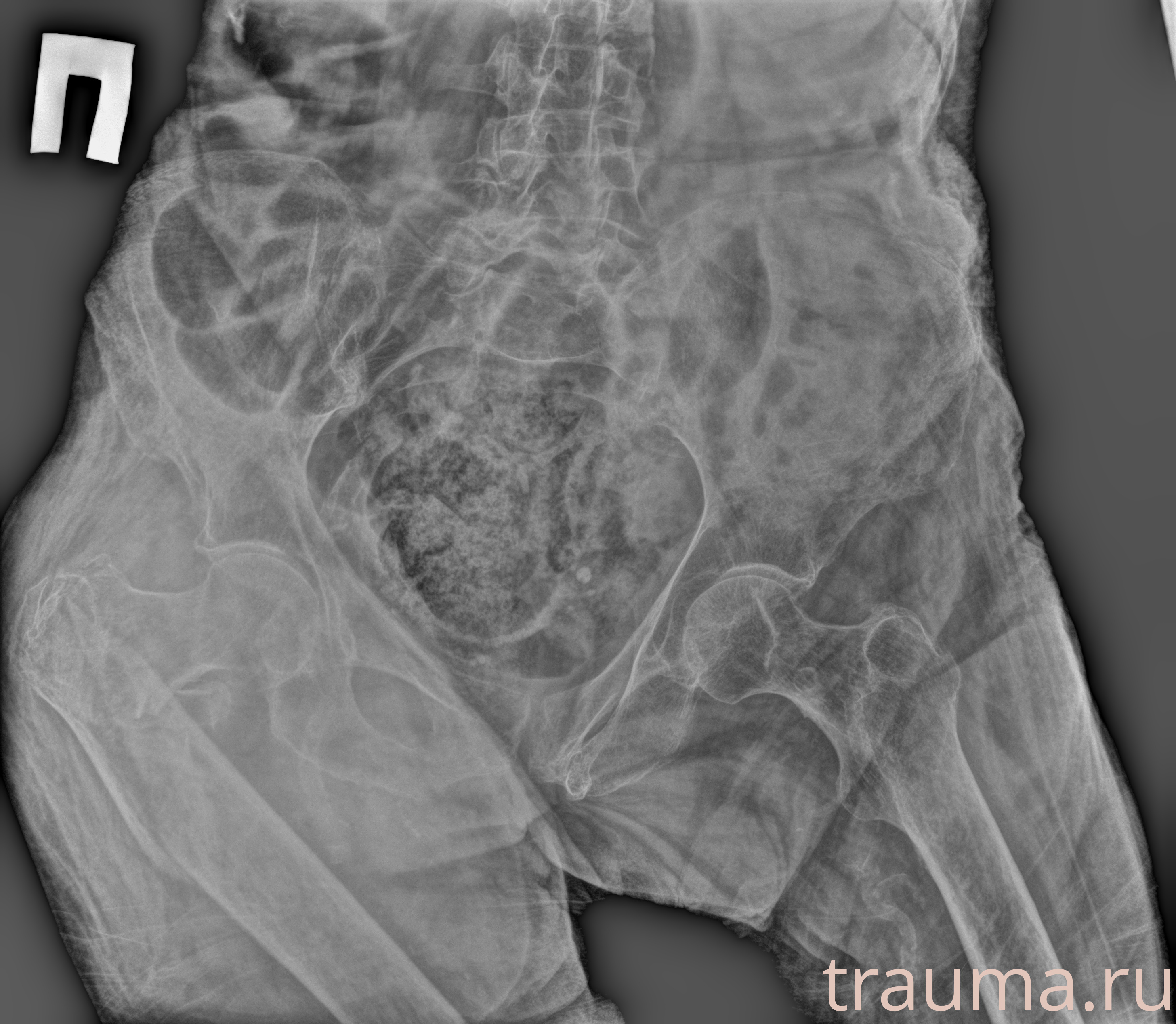 Рентген на дому: по вашему адресу приезжает врач-рентгенолог, травматолог-ортопед с мобильным рентгеновским аппаратом, проводит диагностику травмы или заболевания, делает необходимые рентгенограммы, дает рекомендации по дальнейшему лечению. Получить качественные снимки в домашних условиях возможно благодаря уникальной методике, разработанной МосРентген Центром для института  Склифосовского