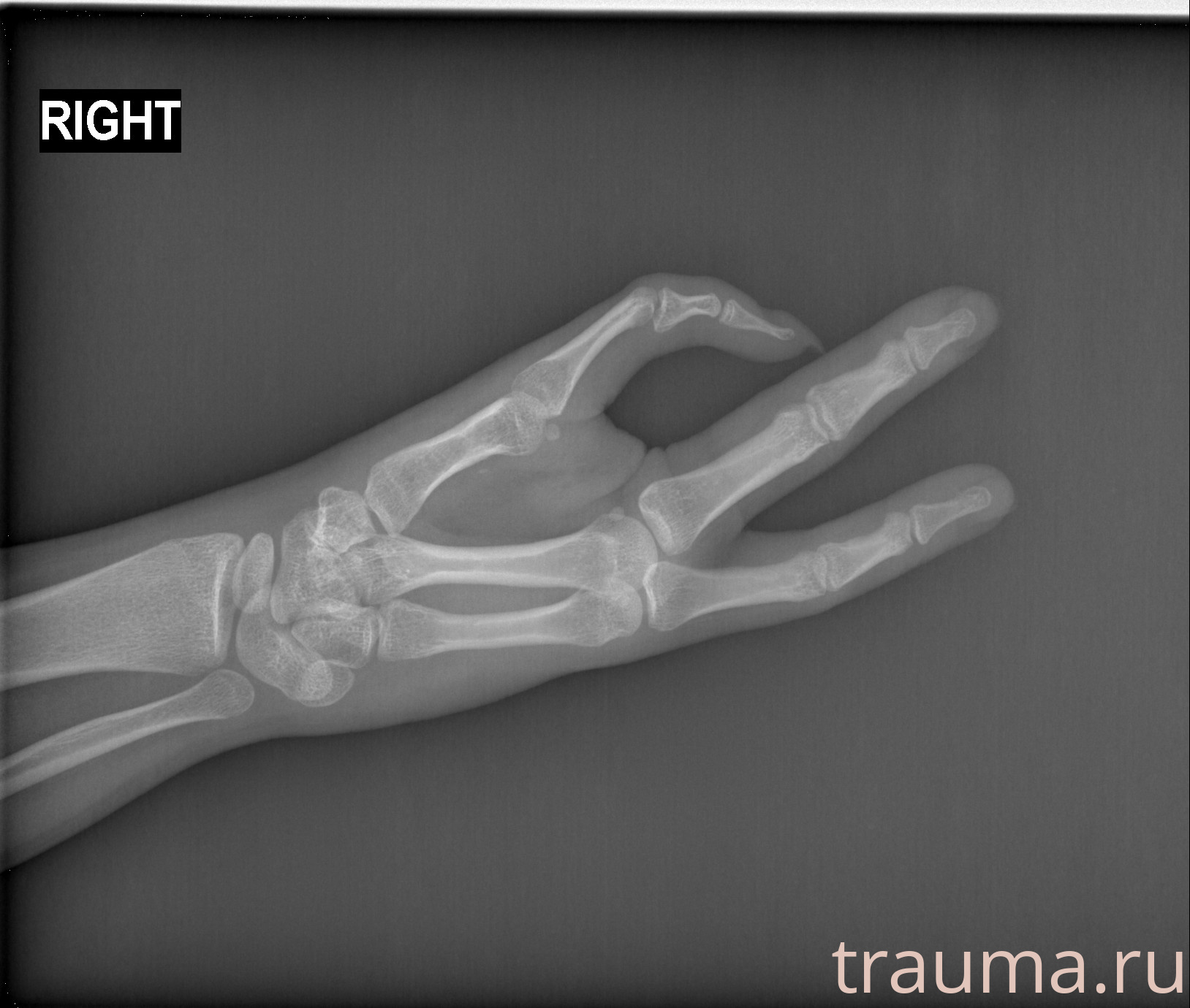 Рентген на дому: по вашему адресу приезжает врач-рентгенолог, травматолог-ортопед с мобильным рентгеновским аппаратом, проводит диагностику травмы или заболевания, делает необходимые рентгенограммы, дает рекомендации по дальнейшему лечению. Получить качественные снимки в домашних условиях возможно благодаря уникальной методике, разработанной МосРентген Центром для института  Склифосовского