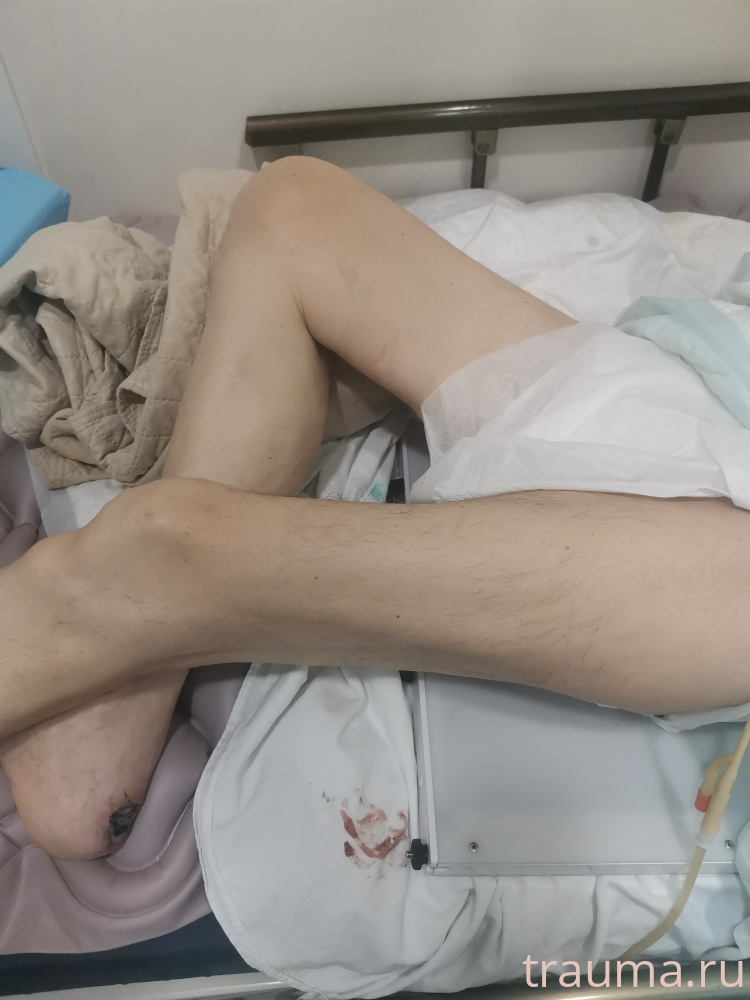Рентген на дому: по вашему адресу приезжает врач-рентгенолог, травматолог-ортопед с мобильным рентгеновским аппаратом, проводит диагностику травмы или заболевания, делает необходимые рентгенограммы, дает рекомендации по дальнейшему лечению. Получить качественные снимки в домашних условиях возможно благодаря уникальной методике, разработанной МосРентген Центром для института  Склифосовского