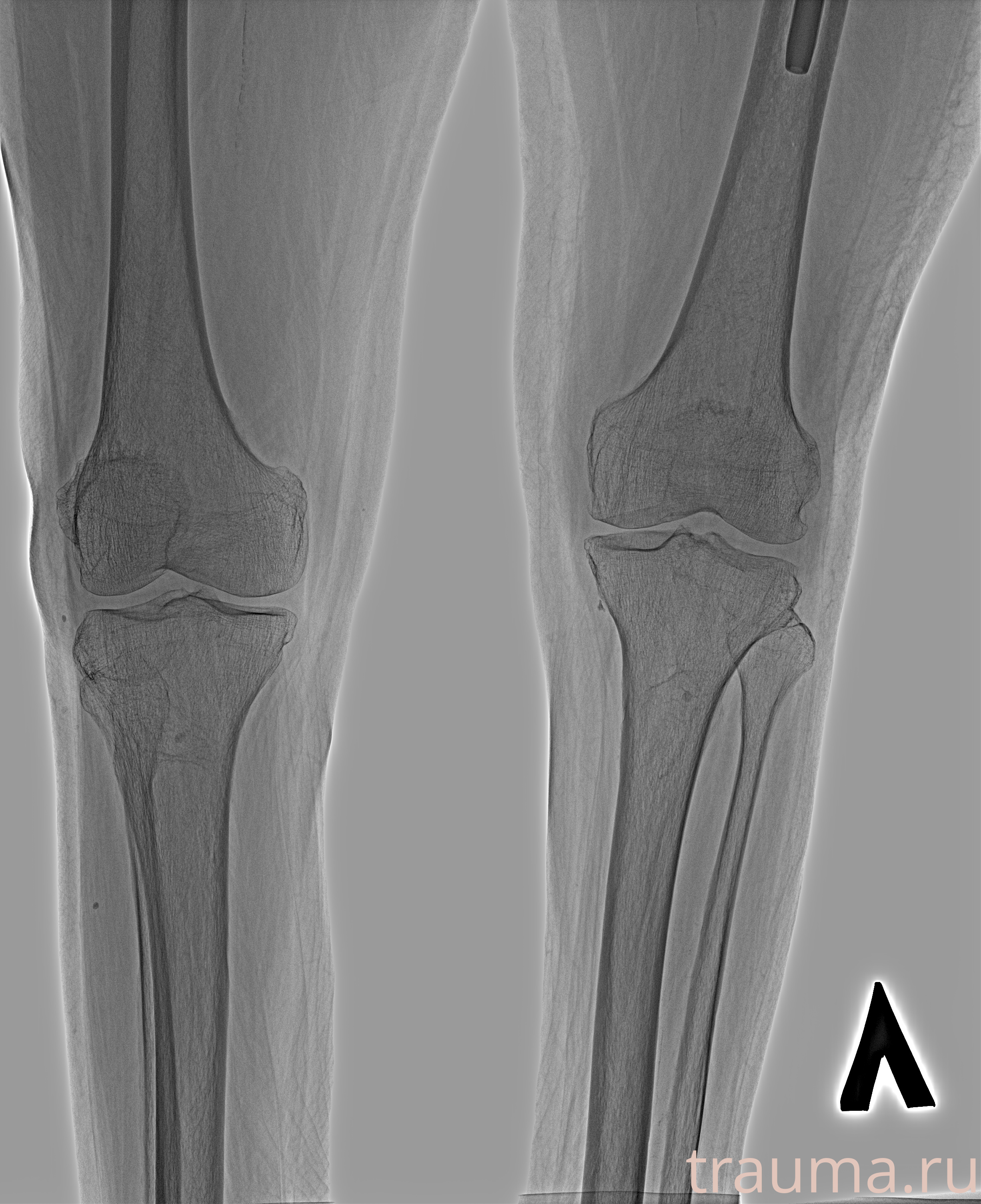 Рентген на дому: по вашему адресу приезжает врач-рентгенолог, травматолог-ортопед с мобильным рентгеновским аппаратом, проводит диагностику травмы или заболевания, делает необходимые рентгенограммы, дает рекомендации по дальнейшему лечению. Получить качественные снимки в домашних условиях возможно благодаря уникальной методике, разработанной МосРентген Центром для института  Склифосовского