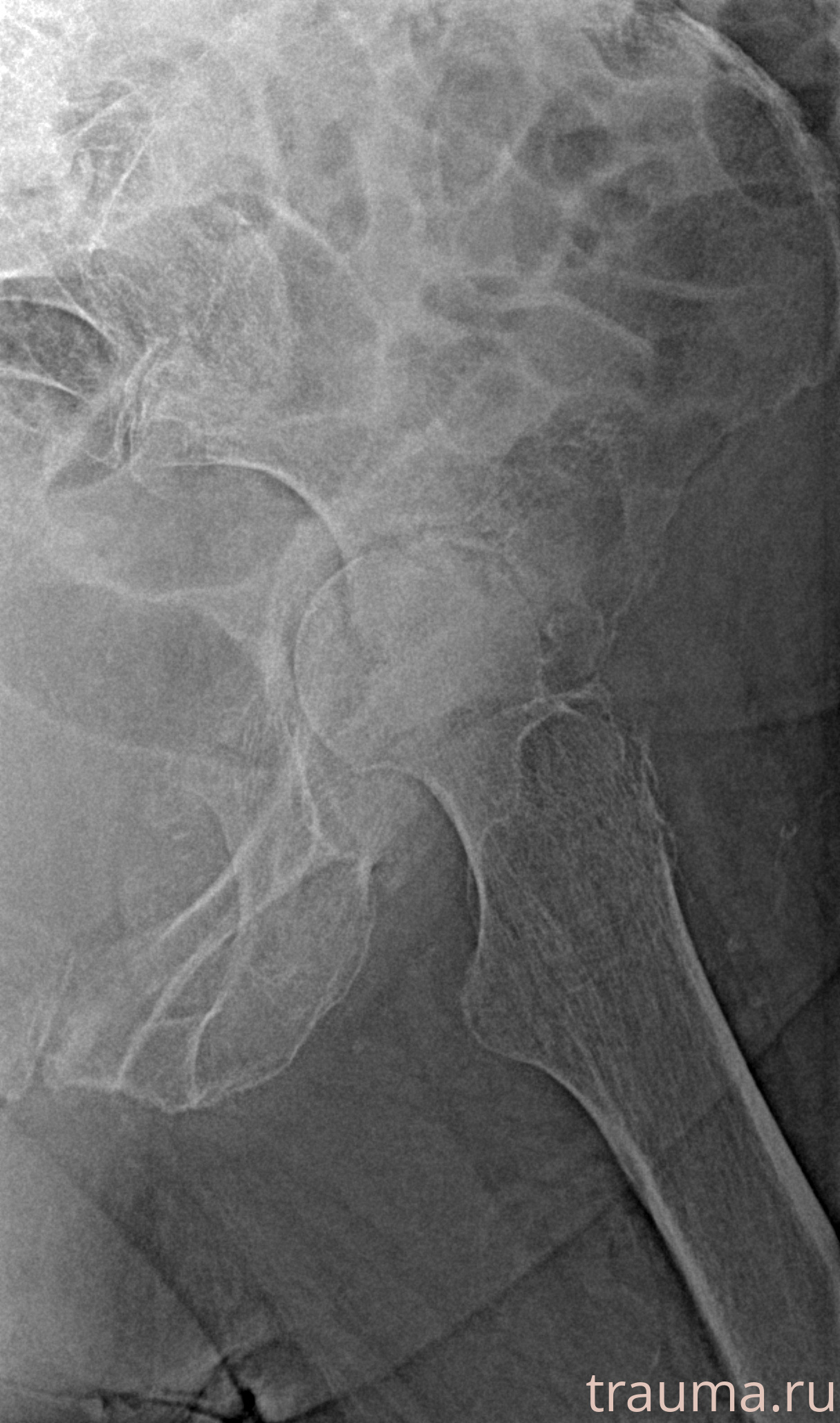 Рентген на дому: по вашему адресу приезжает врач-рентгенолог, травматолог-ортопед с мобильным рентгеновским аппаратом, проводит диагностику травмы или заболевания, делает необходимые рентгенограммы, дает рекомендации по дальнейшему лечению. Получить качественные снимки в домашних условиях возможно благодаря уникальной методике, разработанной МосРентген Центром для института  Склифосовского