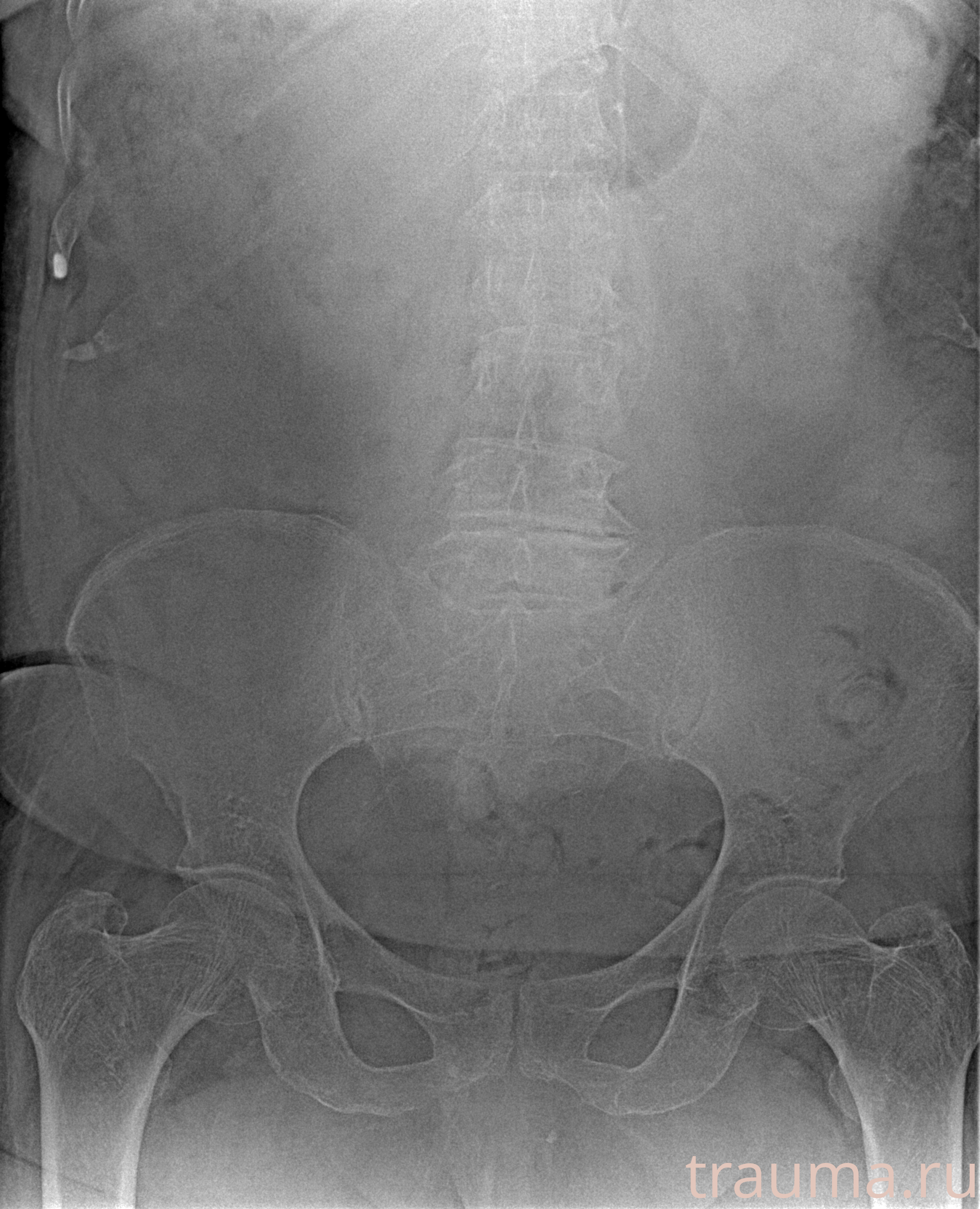 Рентген на дому: по вашему адресу приезжает врач-рентгенолог, травматолог-ортопед с мобильным рентгеновским аппаратом, проводит диагностику травмы или заболевания, делает необходимые рентгенограммы, дает рекомендации по дальнейшему лечению. Получить качественные снимки в домашних условиях возможно благодаря уникальной методике, разработанной МосРентген Центром для института  Склифосовского