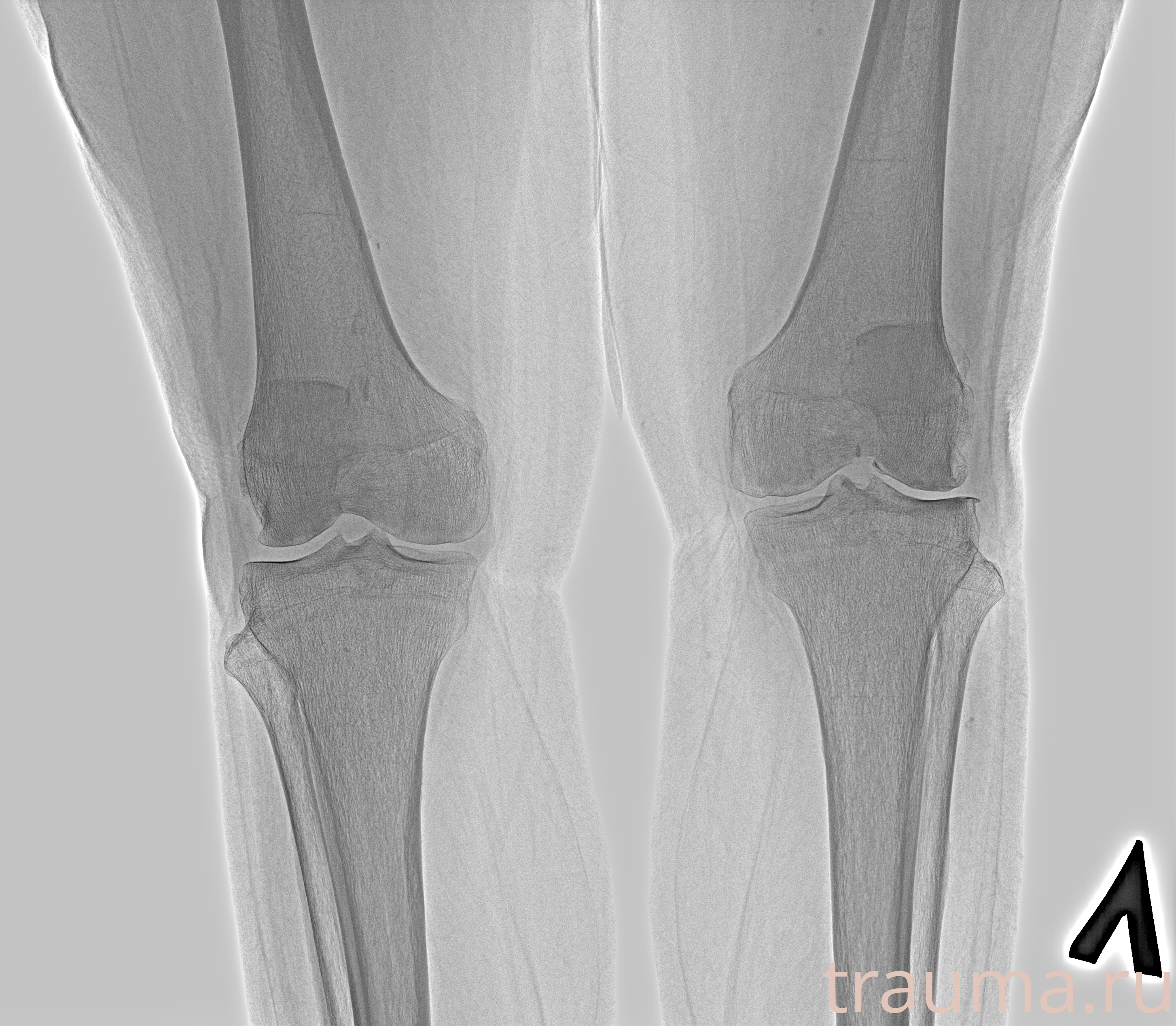 Рентген на дому: по вашему адресу приезжает врач-рентгенолог, травматолог-ортопед с мобильным рентгеновским аппаратом, проводит диагностику травмы или заболевания, делает необходимые рентгенограммы, дает рекомендации по дальнейшему лечению. Получить качественные снимки в домашних условиях возможно благодаря уникальной методике, разработанной МосРентген Центром для института  Склифосовского