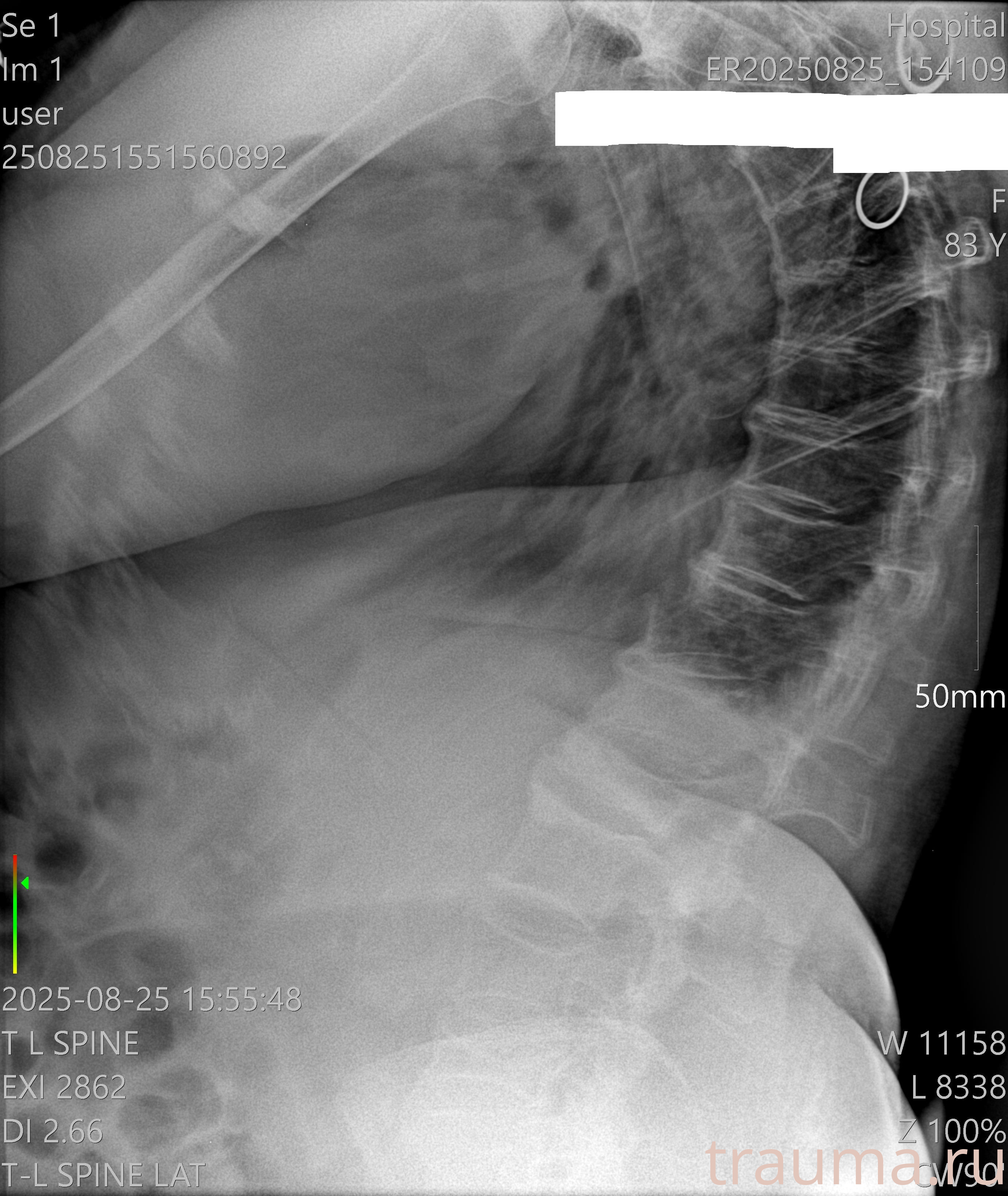 Рентген на дому: по вашему адресу приезжает врач-рентгенолог, травматолог-ортопед с мобильным рентгеновским аппаратом, проводит диагностику травмы или заболевания, делает необходимые рентгенограммы, дает рекомендации по дальнейшему лечению. Получить качественные снимки в домашних условиях возможно благодаря уникальной методике, разработанной МосРентген Центром для института  Склифосовского