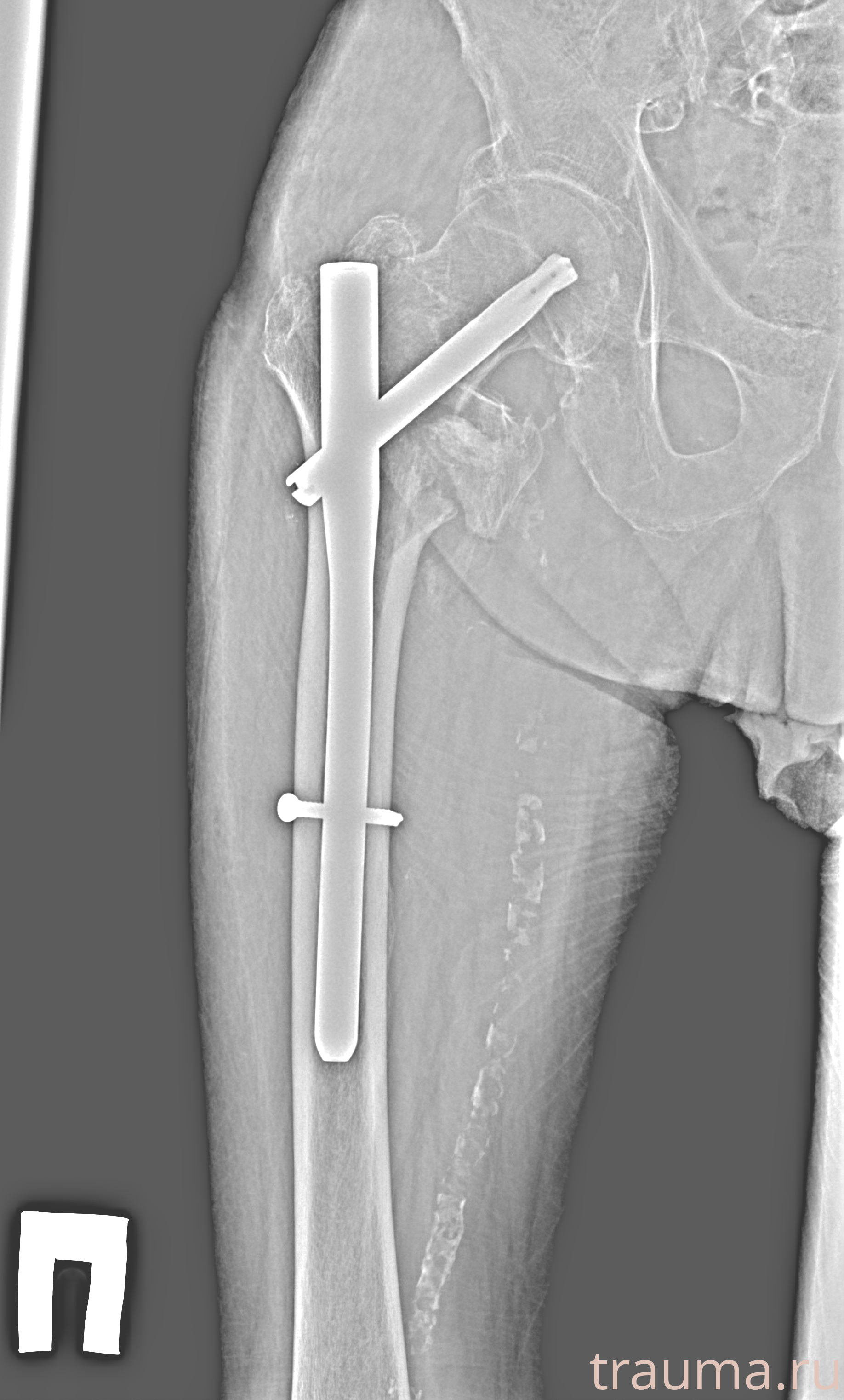 Рентген на дому: по вашему адресу приезжает врач-рентгенолог, травматолог-ортопед с мобильным рентгеновским аппаратом, проводит диагностику травмы или заболевания, делает необходимые рентгенограммы, дает рекомендации по дальнейшему лечению. Получить качественные снимки в домашних условиях возможно благодаря уникальной методике, разработанной МосРентген Центром для института  Склифосовского