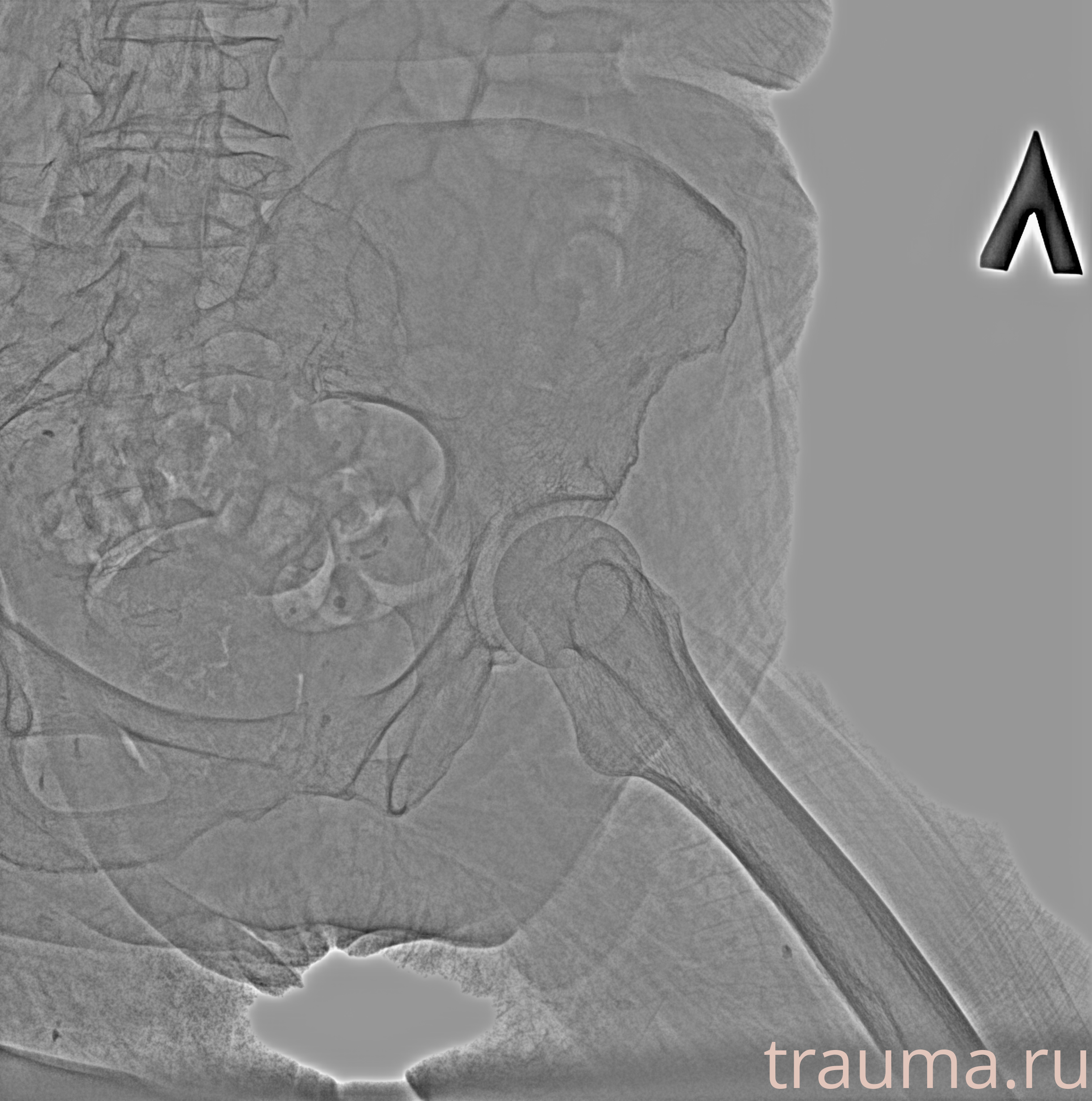Рентген на дому: по вашему адресу приезжает врач-рентгенолог, травматолог-ортопед с мобильным рентгеновским аппаратом, проводит диагностику травмы или заболевания, делает необходимые рентгенограммы, дает рекомендации по дальнейшему лечению. Получить качественные снимки в домашних условиях возможно благодаря уникальной методике, разработанной МосРентген Центром для института  Склифосовского