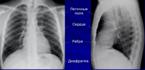 Рентгеноанатомические основы исследования легких. Глава 1 Рентгеноанатомические основы исследования легких. Глава 1