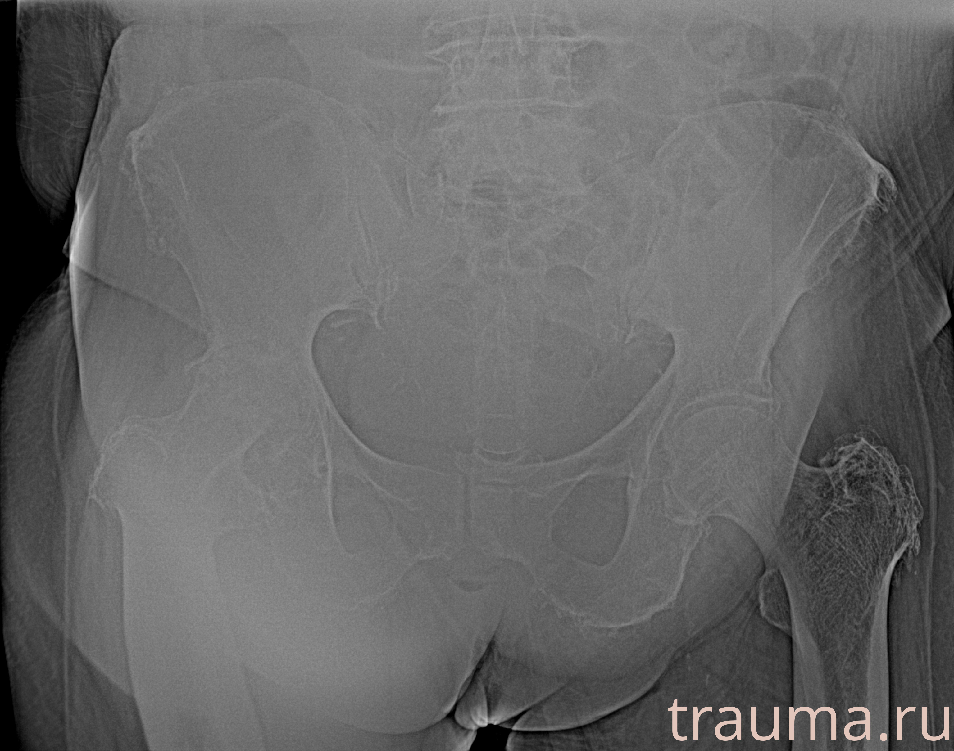 Рентген на дому: по вашему адресу приезжает врач-рентгенолог, травматолог-ортопед с мобильным рентгеновским аппаратом, проводит диагностику травмы или заболевания, делает необходимые рентгенограммы, дает рекомендации по дальнейшему лечению. Получить качественные снимки в домашних условиях возможно благодаря уникальной методике, разработанной МосРентген Центром для института  Склифосовского