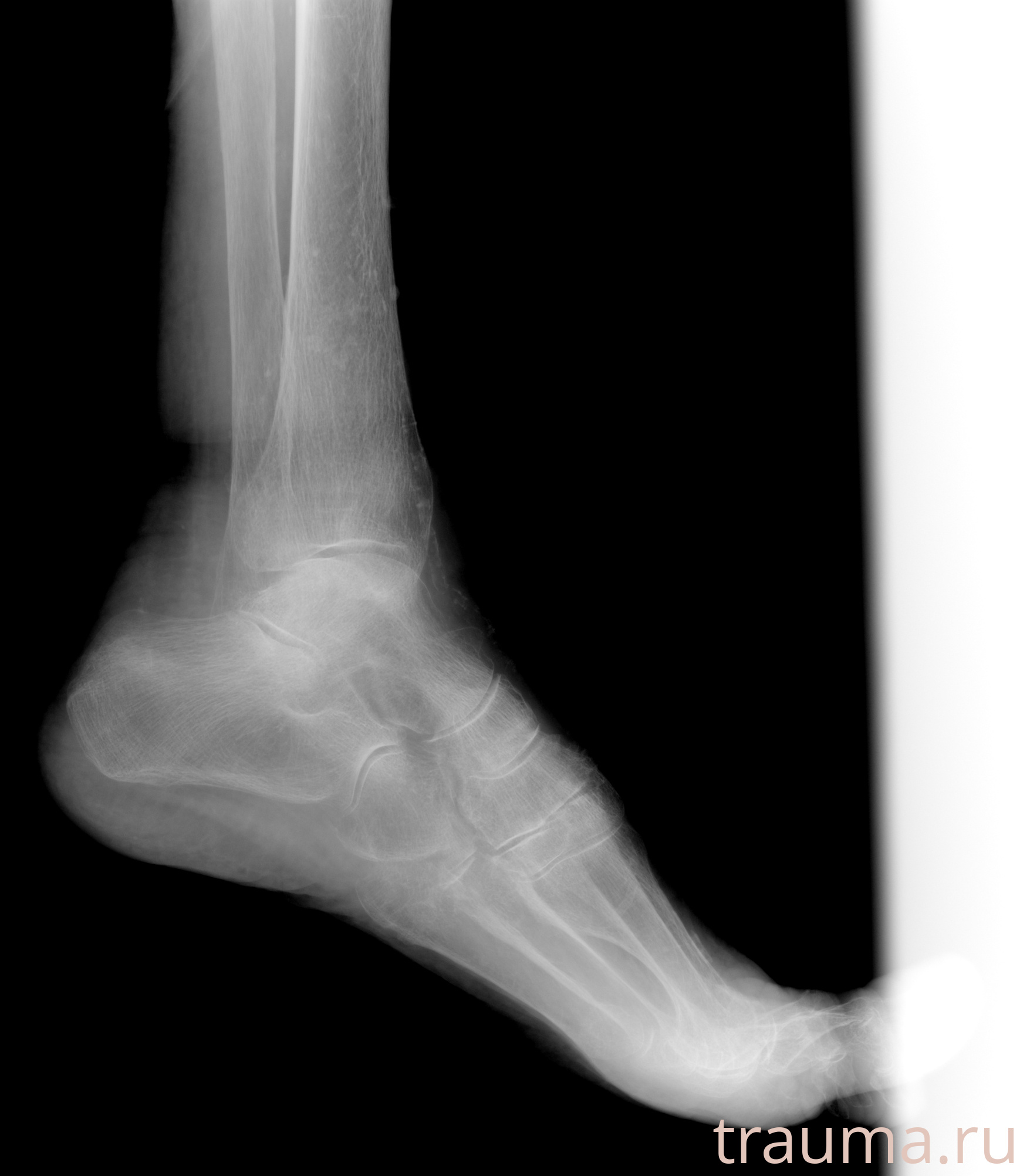 Рентген на дому: по вашему адресу приезжает врач-рентгенолог, травматолог-ортопед с мобильным рентгеновским аппаратом, проводит диагностику травмы или заболевания, делает необходимые рентгенограммы, дает рекомендации по дальнейшему лечению. Получить качественные снимки в домашних условиях возможно благодаря уникальной методике, разработанной МосРентген Центром для института  Склифосовского