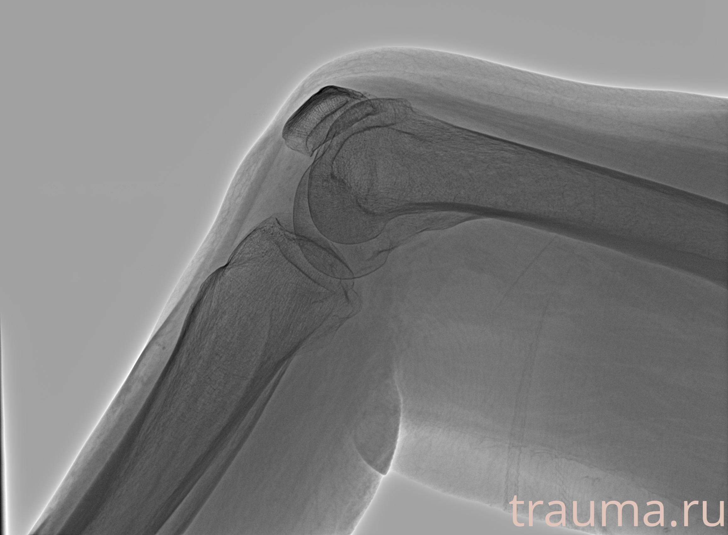 Рентген на дому: по вашему адресу приезжает врач-рентгенолог, травматолог-ортопед с мобильным рентгеновским аппаратом, проводит диагностику травмы или заболевания, делает необходимые рентгенограммы, дает рекомендации по дальнейшему лечению. Получить качественные снимки в домашних условиях возможно благодаря уникальной методике, разработанной МосРентген Центром для института  Склифосовского