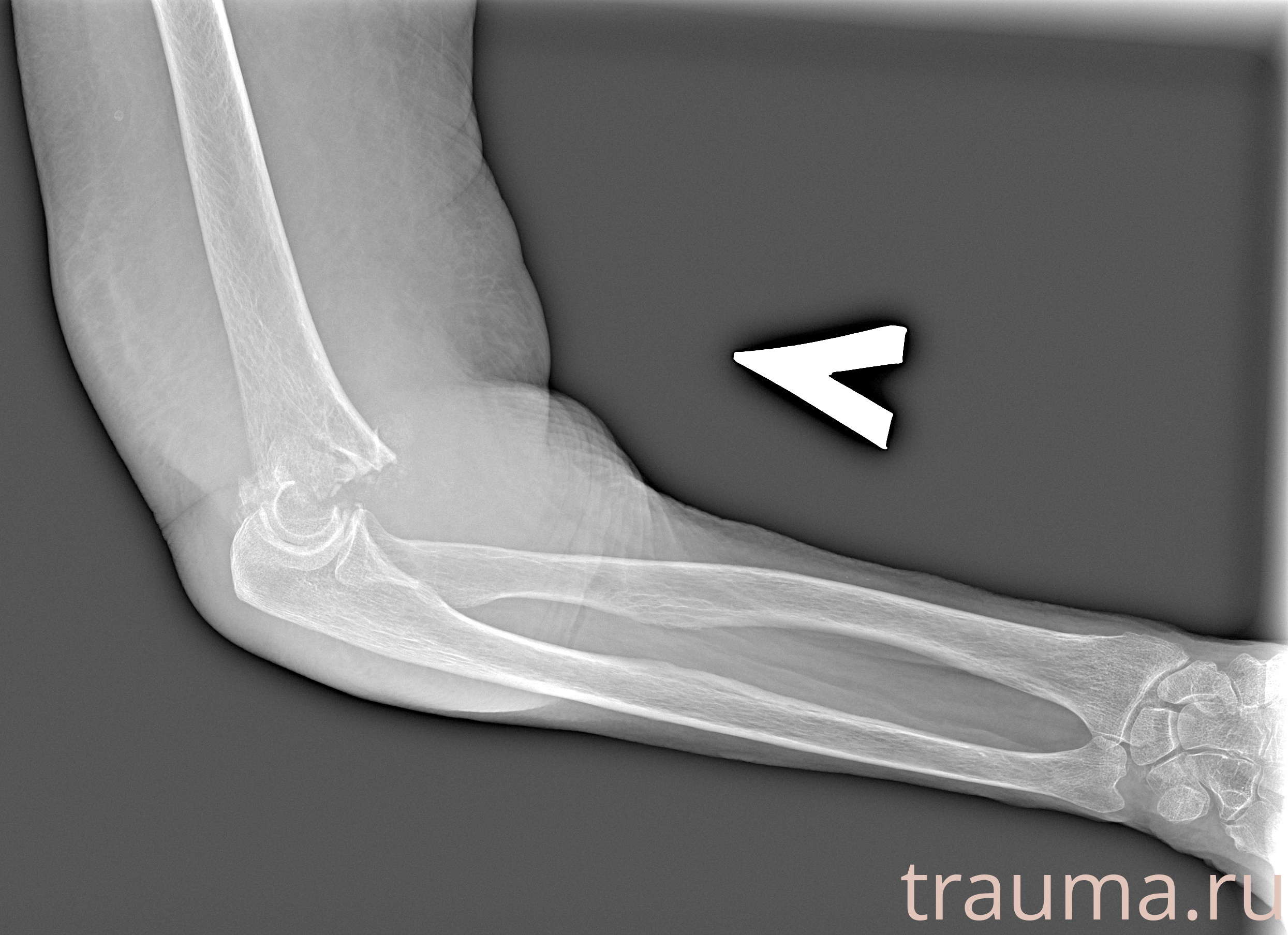 Рентген на дому: по вашему адресу приезжает врач-рентгенолог, травматолог-ортопед с мобильным рентгеновским аппаратом, проводит диагностику травмы или заболевания, делает необходимые рентгенограммы, дает рекомендации по дальнейшему лечению. Получить качественные снимки в домашних условиях возможно благодаря уникальной методике, разработанной МосРентген Центром для института  Склифосовского