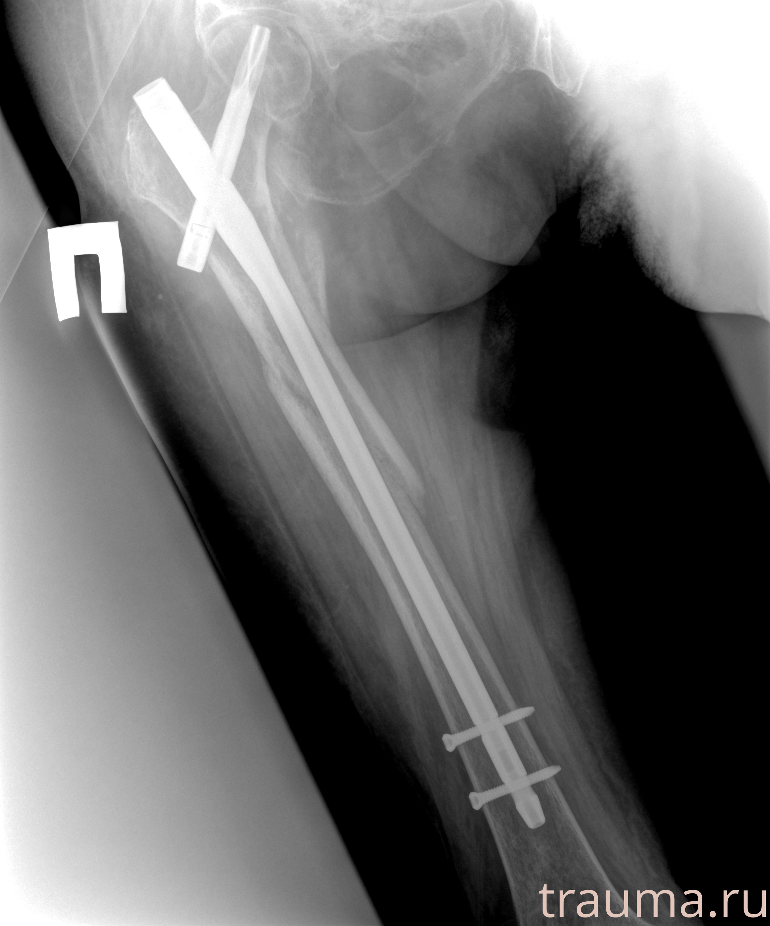 Рентген на дому: по вашему адресу приезжает врач-рентгенолог, травматолог-ортопед с мобильным рентгеновским аппаратом, проводит диагностику травмы или заболевания, делает необходимые рентгенограммы, дает рекомендации по дальнейшему лечению. Получить качественные снимки в домашних условиях возможно благодаря уникальной методике, разработанной МосРентген Центром для института  Склифосовского