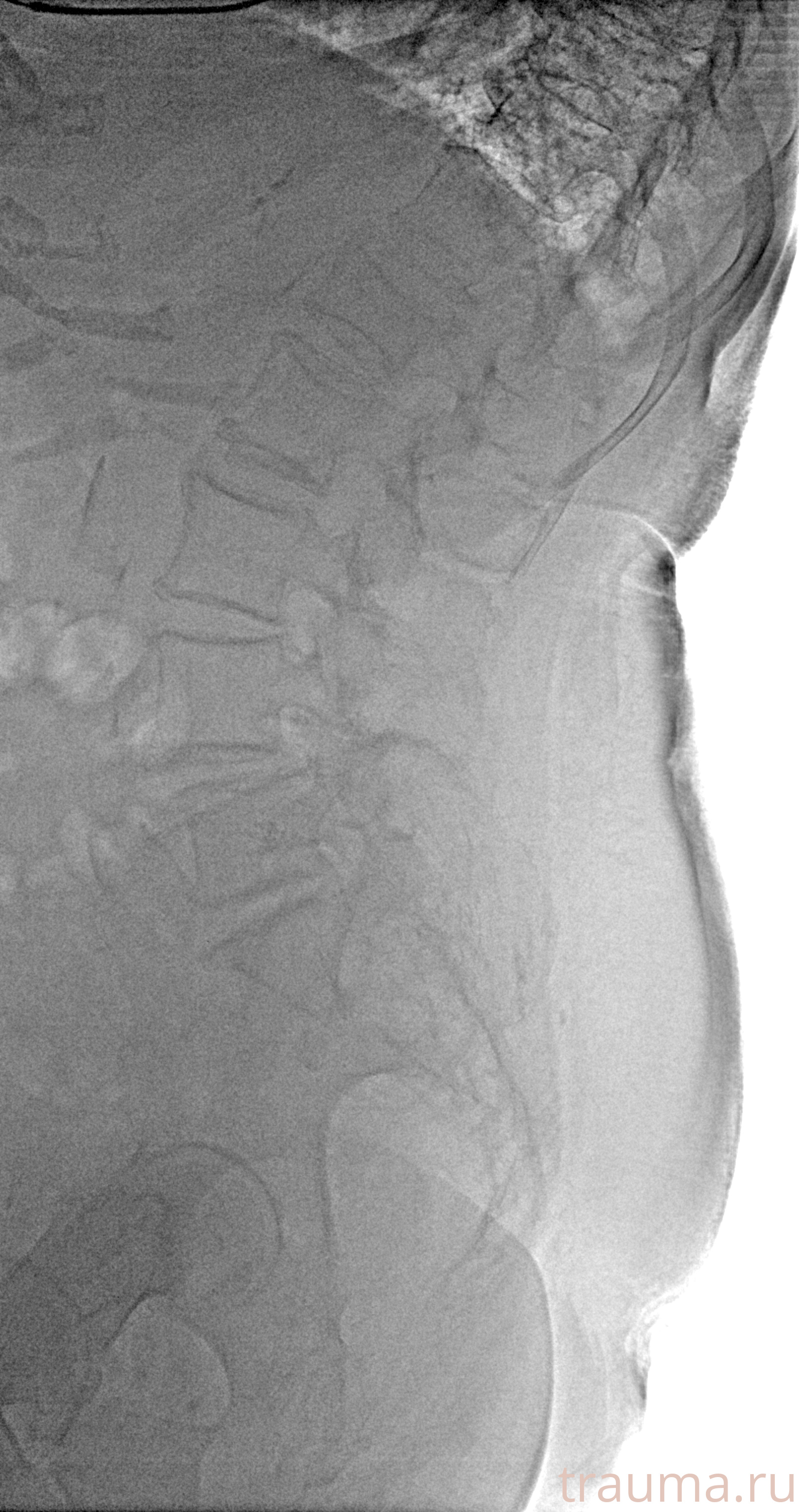 Рентген на дому: по вашему адресу приезжает врач-рентгенолог, травматолог-ортопед с мобильным рентгеновским аппаратом, проводит диагностику травмы или заболевания, делает необходимые рентгенограммы, дает рекомендации по дальнейшему лечению. Получить качественные снимки в домашних условиях возможно благодаря уникальной методике, разработанной МосРентген Центром для института  Склифосовского