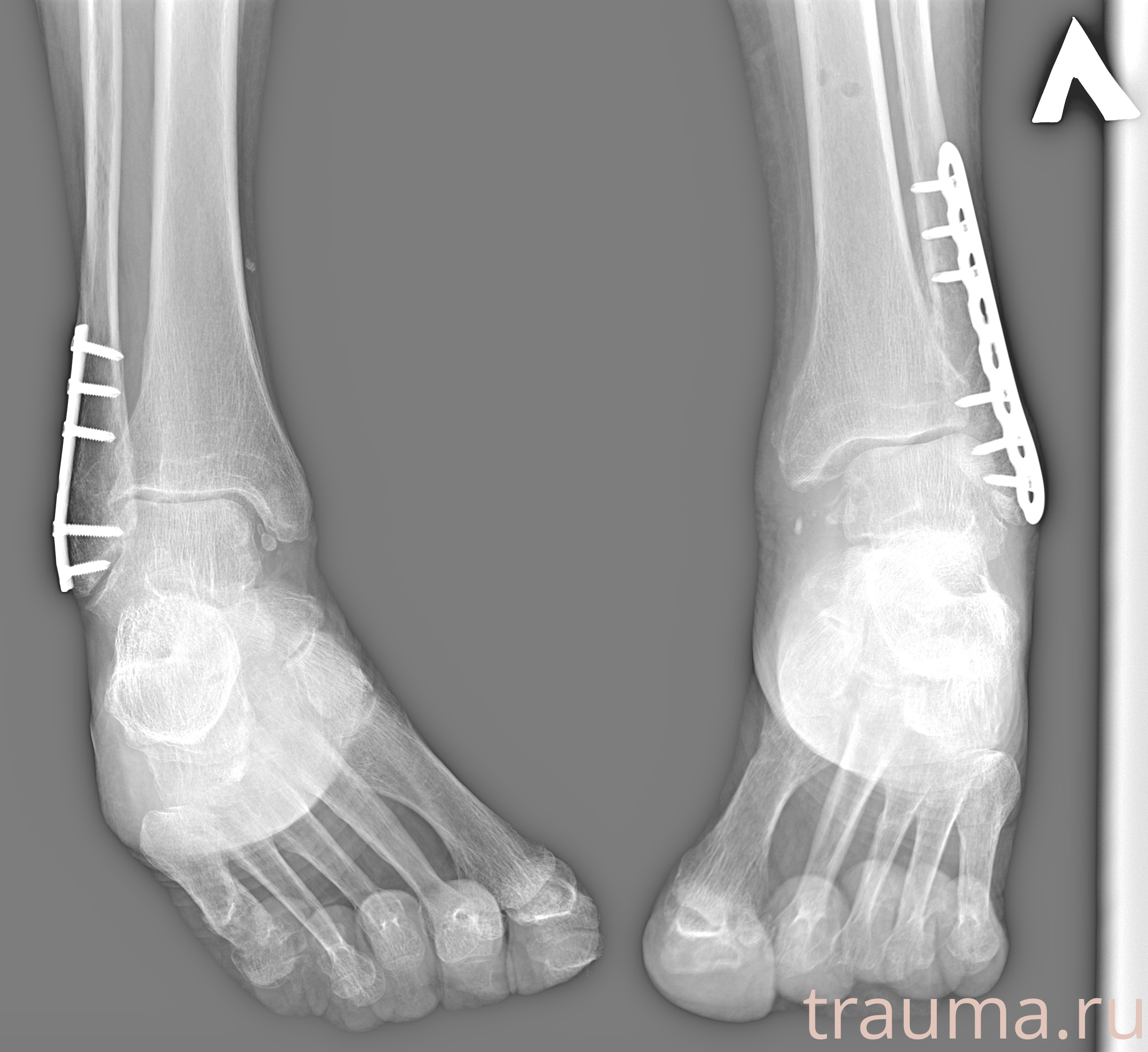 Рентген на дому: по вашему адресу приезжает врач-рентгенолог, травматолог-ортопед с мобильным рентгеновским аппаратом, проводит диагностику травмы или заболевания, делает необходимые рентгенограммы, дает рекомендации по дальнейшему лечению. Получить качественные снимки в домашних условиях возможно благодаря уникальной методике, разработанной МосРентген Центром для института  Склифосовского