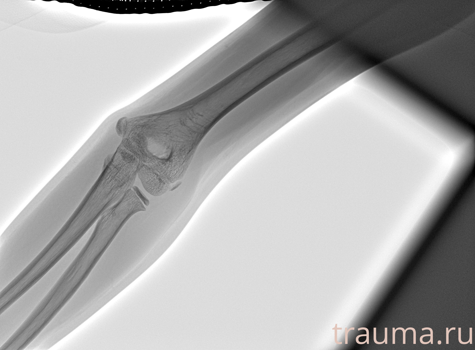 Рентген на дому: по вашему адресу приезжает врач-рентгенолог, травматолог-ортопед с мобильным рентгеновским аппаратом, проводит диагностику травмы или заболевания, делает необходимые рентгенограммы, дает рекомендации по дальнейшему лечению. Получить качественные снимки в домашних условиях возможно благодаря уникальной методике, разработанной МосРентген Центром для института  Склифосовского