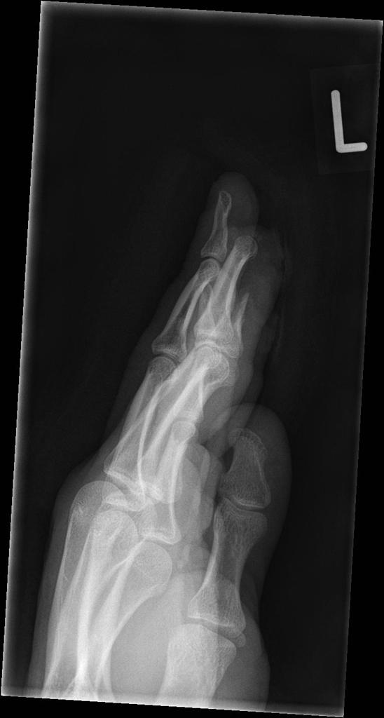 distal-phalynx-amputation53.jpg distal-phalynx-amputation53.jpg