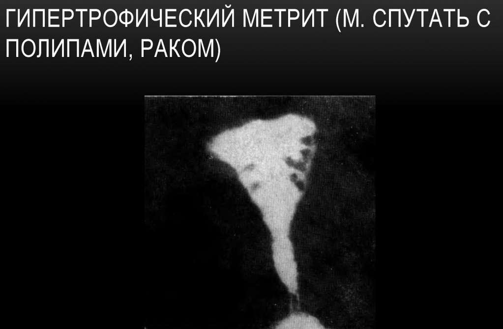 Гипертрофический метрит Гипертрофический метрит