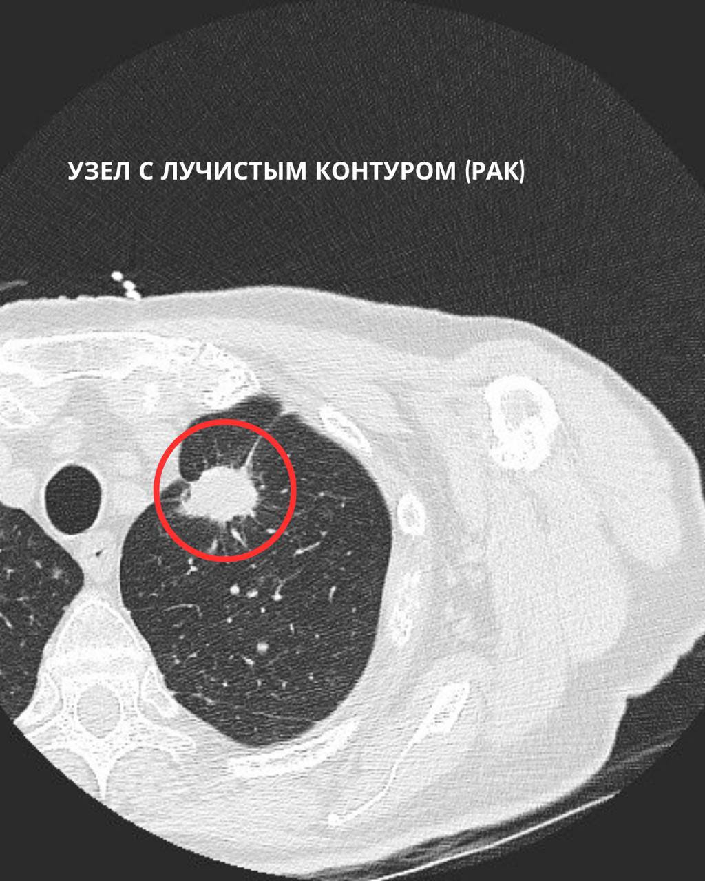 Рак легкого Рак легкого