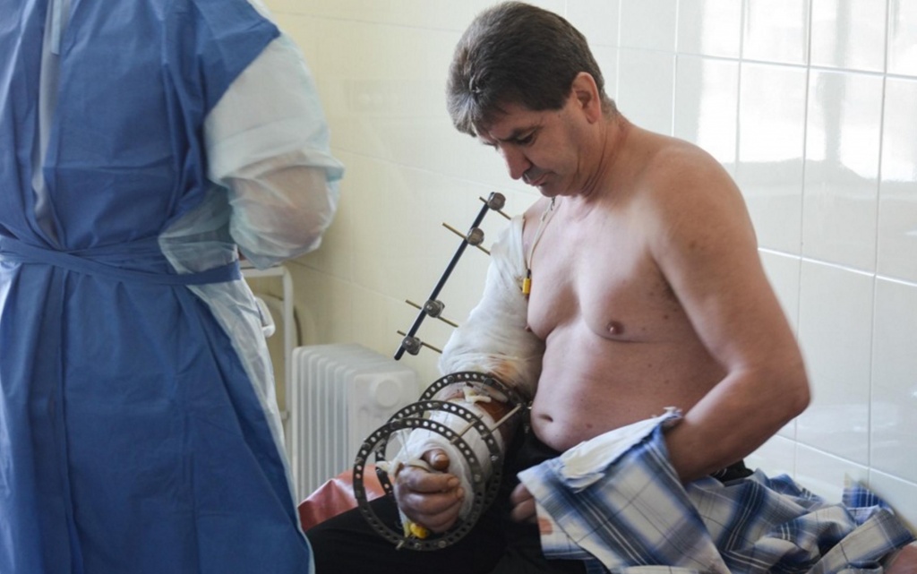 Аппарат Илизарова и стержневой аппарат на руке