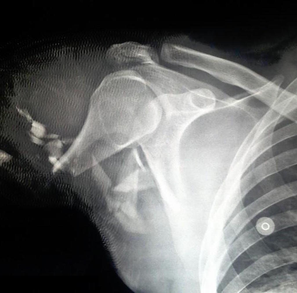 traumatic-arm-amputation-9.jpg traumatic-arm-amputation-9.jpg