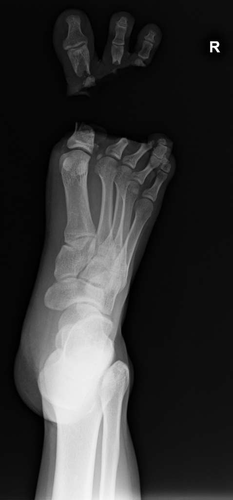 traumatic-toe-amputation7.jpg traumatic-toe-amputation7.jpg