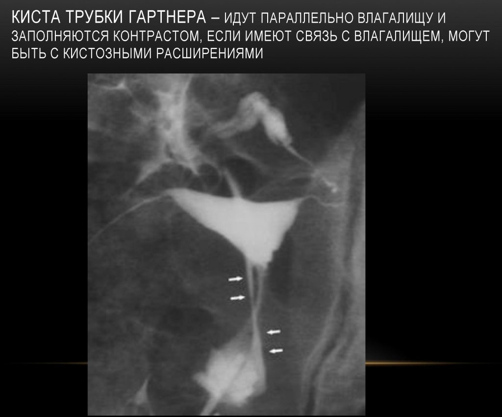 Киста трубки Гартнера Киста трубки Гартнера