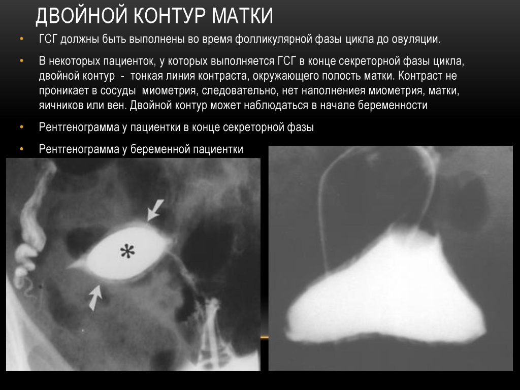 Двойной контур матки при беременности и выполеннии ГСГ Двойной контур матки при беременности и выполеннии ГСГ
