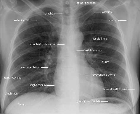 pa_chest_xray.gif pa_chest_xray.gif