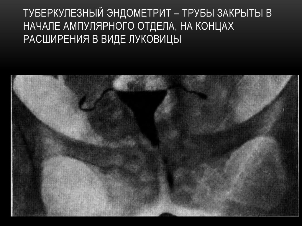 Туберкулезный эндометрит Туберкулезный эндометрит