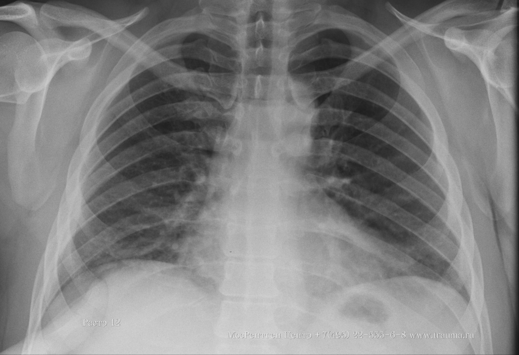 Рентгенограмма грудной клетки. Рентгенаппарат Арман 10Л6-011 и рентгеновский оцифровщик Vita CR Carestream.