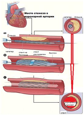 stenoz_pri_coronarografii.jpg