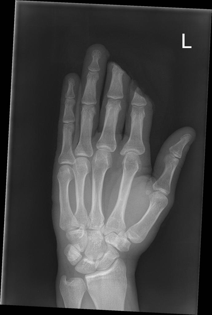 distal-phalynx-amputation51.jpg distal-phalynx-amputation51.jpg