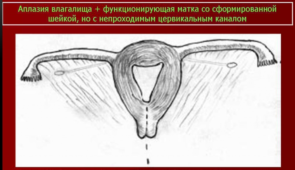 Синдром Майера-Рокитанского-Кюстера - наследственные аномалии развития матки (возможно, аутосомно-доминантное наследование).В анамнезе первичная аменорея, стерильность; нормальное развитие вторичных половых признаков и нормальное появление менструаций. Иногда викарирующие кровотечения из мочевого пузыря, прямой кишки, полости рта или носа. Наружные гениталии: общая гипоплазия, часто дорсальное расположение и воронкообразное расширение отверстий мочеиспускательного канала. Внутренние гениталии — влагалище почти полностью отсутствует; матка обычно разделена на 2 части, без полости, эндометрий отсутствует; яичники расположены относительно высоко, яйцевод гипопластический, но с просветом. Вторичные половые признаки: нормальный женский внешний облик, развитие молочных желез нормальное, оволосение типично для женского пола. Нормальное половое влечение. Овариальная функция: нормальная базальная температура, нормальное содержание прегнандиола и эстрогенов в моче. Нередко сочетается с аномалиями почек и мочевых путей; иногда наблюдаются врожденная аневризма аорты, аномалии мезентерия, сакрализация 5 поясничного позвонка, гипоплазия XII ребра. Синдром Майера-Рокитанского-Кюстера - наследственные аномалии развития матки (возможно, аутосомно-доминантное наследование).В анамнезе первичная аменорея, стерильность; нормальное развитие вторичных половых признаков и нормальное появление менструаций. Иногда викарирующие кровотечения из мочевого пузыря, прямой кишки, полости рта или носа. Наружные гениталии: общая гипоплазия, часто дорсальное расположение и воронкообразное расширение отверстий мочеиспускательного канала. Внутренние гениталии — влагалище почти полностью отсутствует; матка обычно разделена на 2 части, без полости, эндометрий отсутствует; яичники расположены относительно высоко, яйцевод гипопластический, но с просветом. Вторичные половые признаки: нормальный женский внешний облик, развитие молочных желез нормальное, оволосение типично для женского пола. Нормальное половое влечение. Овариальная функция: нормальная базальная температура, нормальное содержание прегнандиола и эстрогенов в моче. Нередко сочетается с аномалиями почек и мочевых путей; иногда наблюдаются врожденная аневризма аорты, аномалии мезентерия, сакрализация 5 поясничного позвонка, гипоплазия XII ребра.